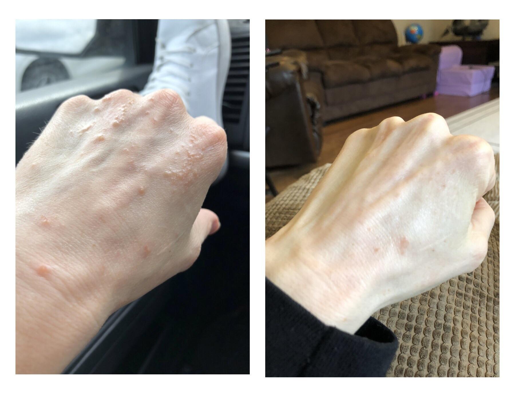 I think I might’ve found my contact dermatitis trigger… fingers crossed