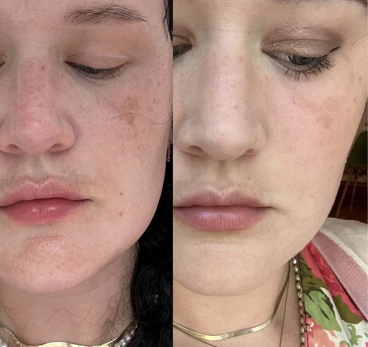 [Before&After] 40F, progress after significant sun damage! r