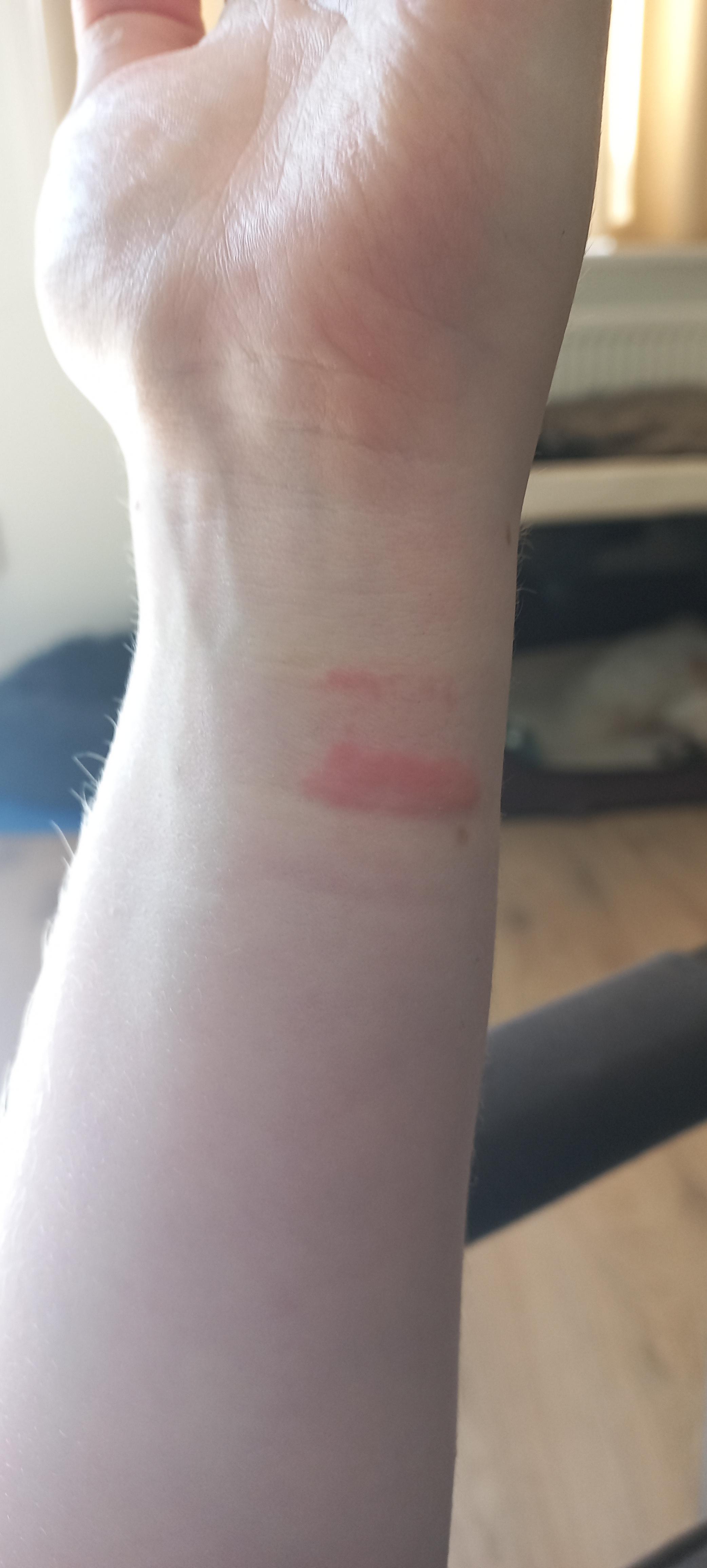 I'm getting skin rash from my watch. It has a silicone strap an ex