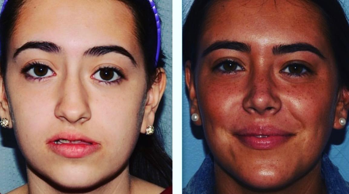 My Before & After. Double Two Surgery and Genioplasty In Korea. 2 years