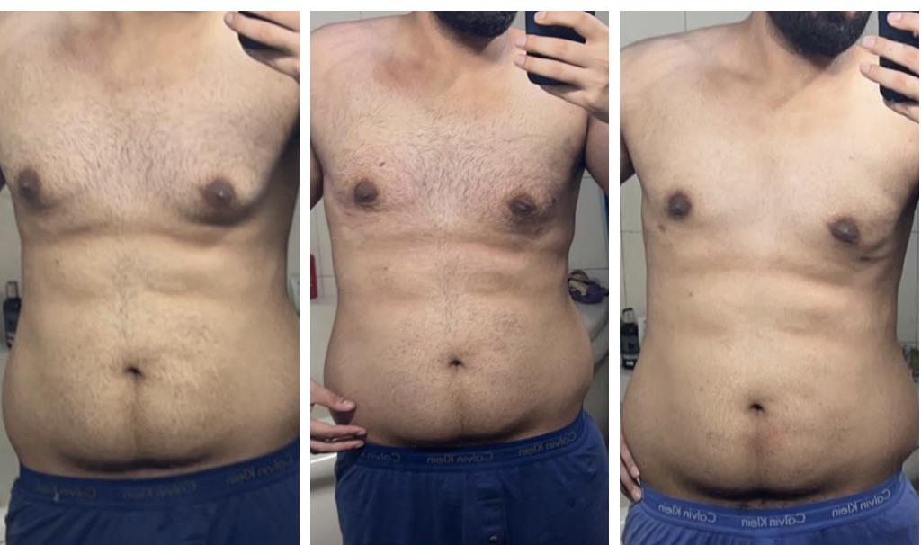 Gyno surgery a month back, results so far. Presurgery > Post surgery