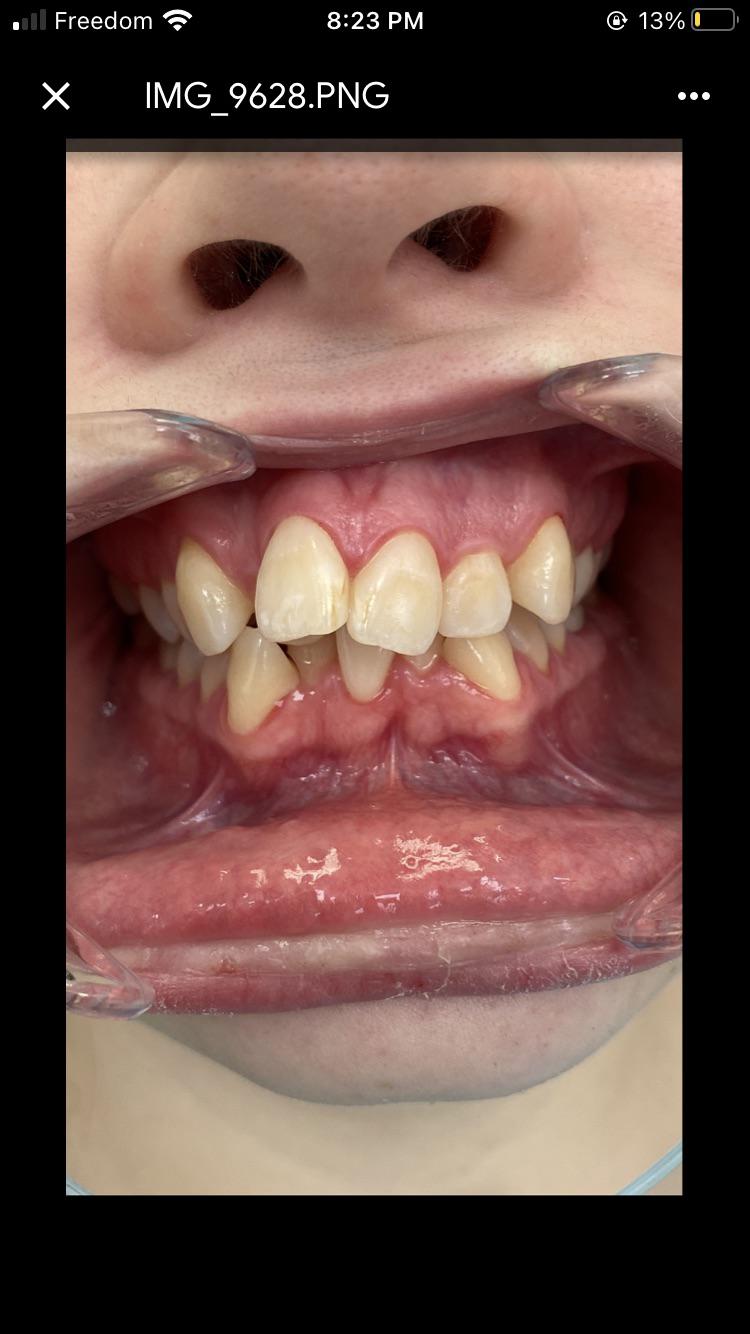 How tf do I make my rubber bands in my mouth not yellow