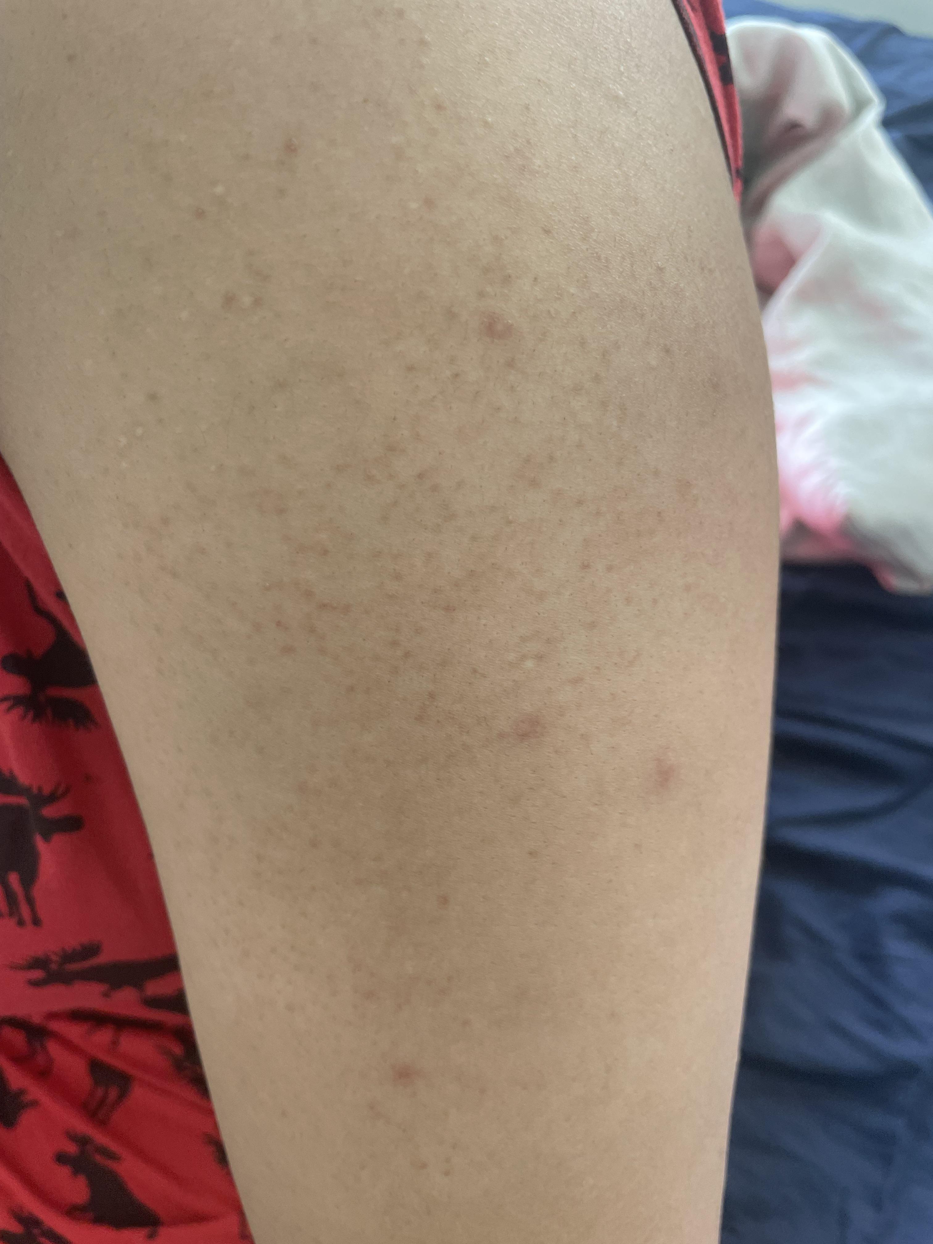 [Skin concern] Help! I have these red dots on both my upper arms. Had