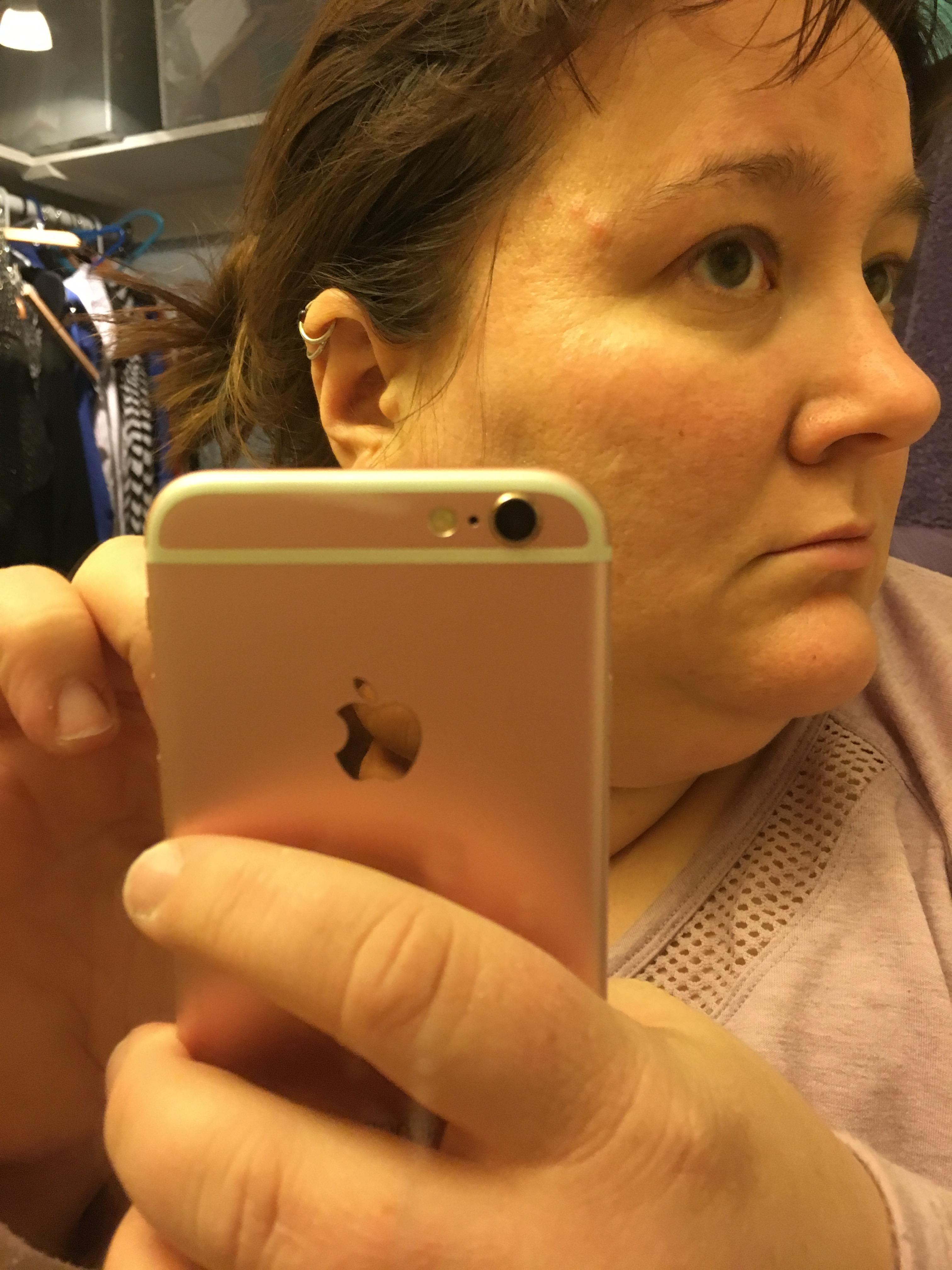 Three bumps on my temple. . .pimples? Dermatology