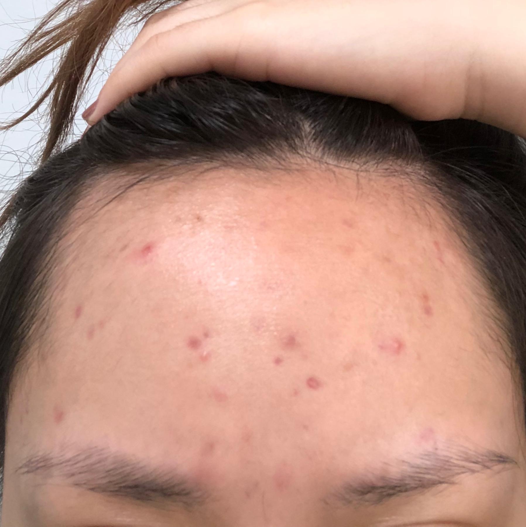 [Routine Help] Should I add an AHA or BHA? (oily/dehydrated, acne prone
