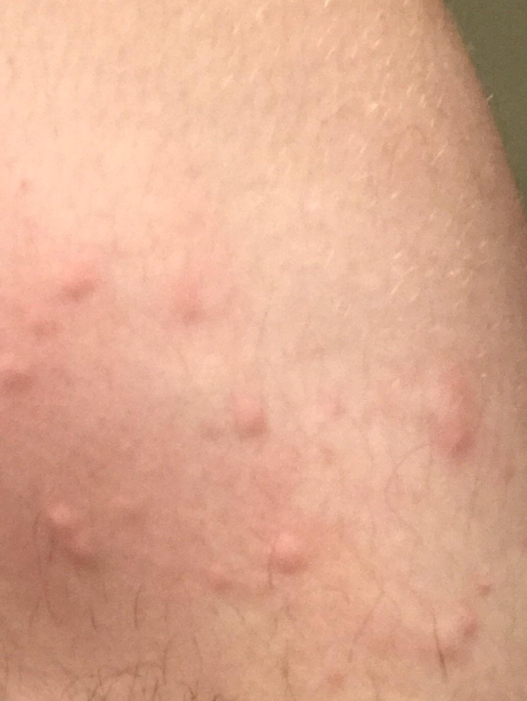 Are these bed bug bites. Bedbugs