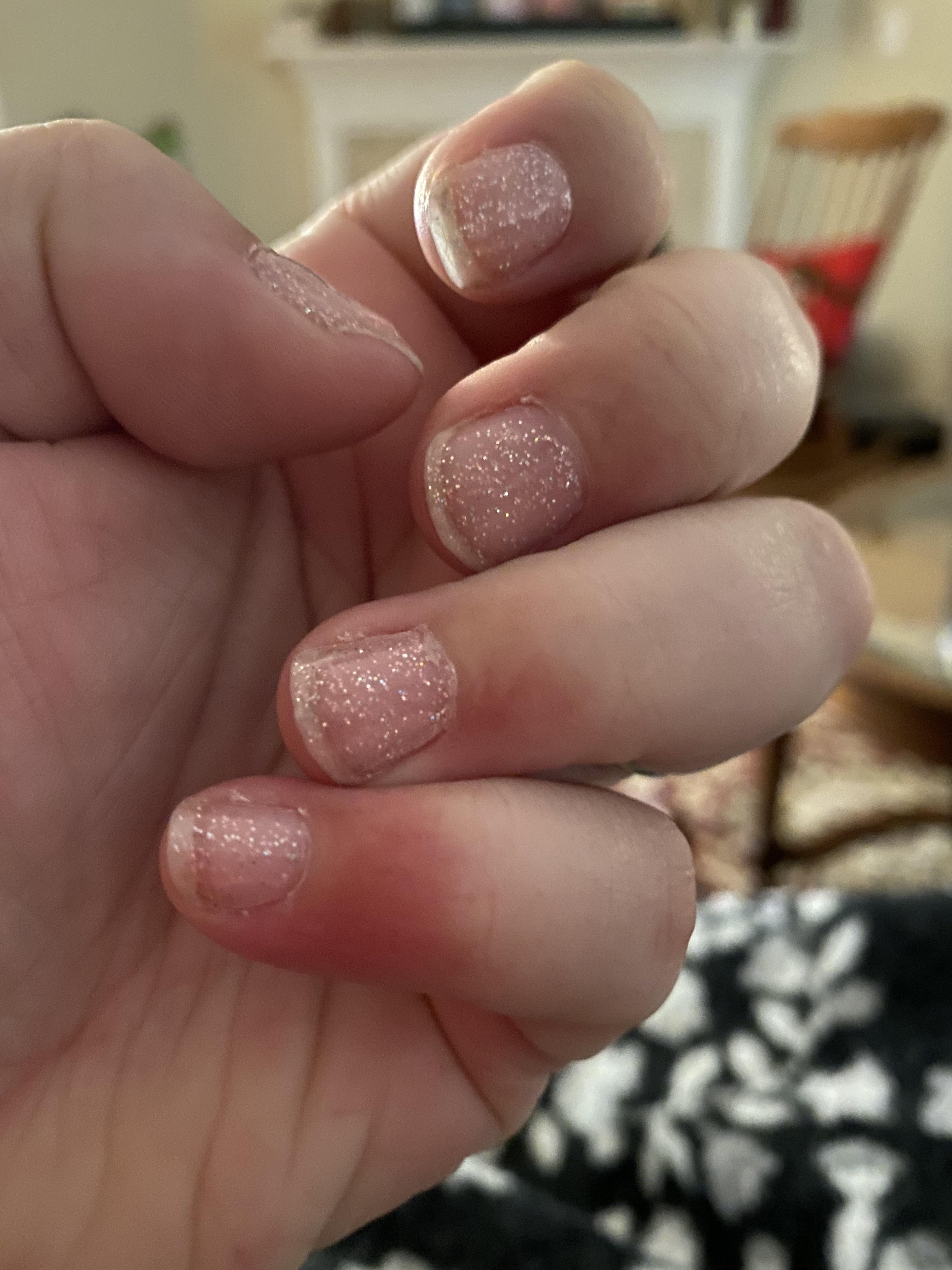 Docs always say it’s eczema? Why do my fingertips do this? Doesn’t hurt
