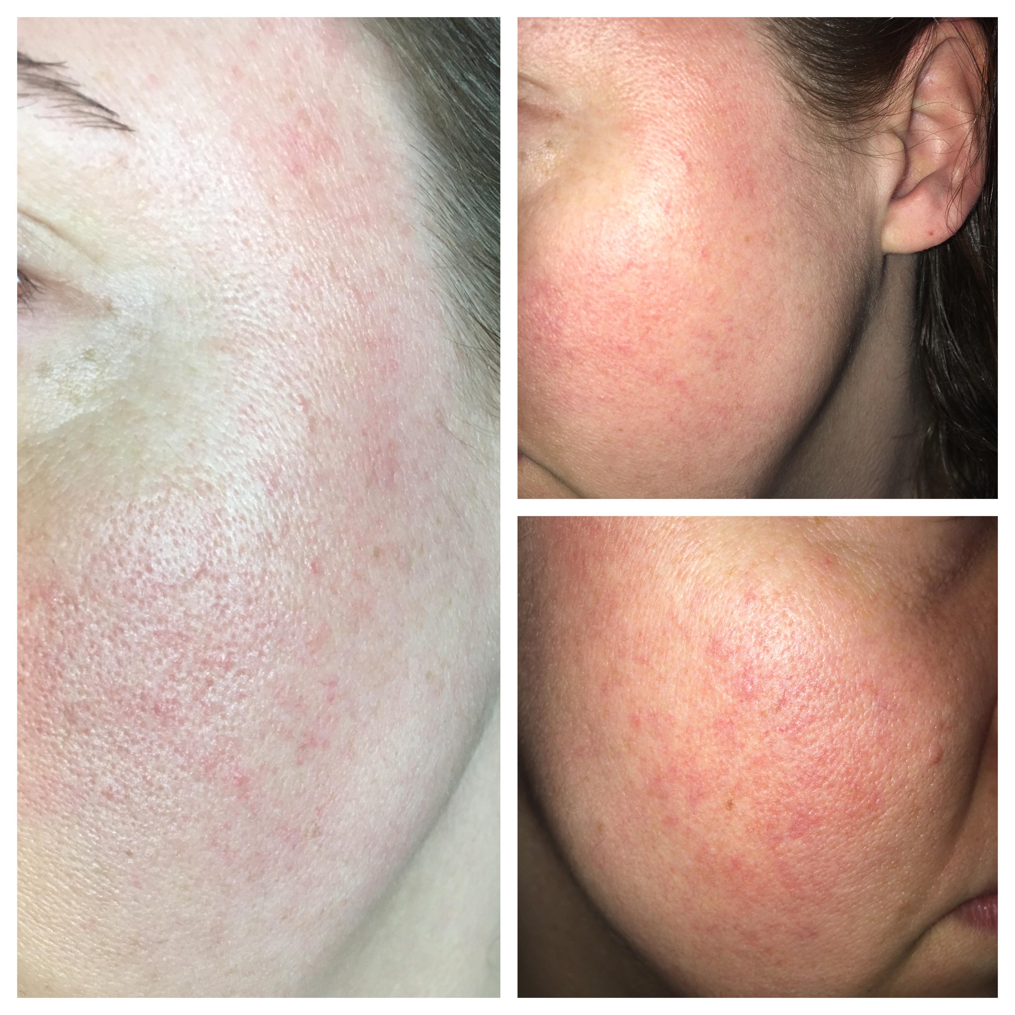 Rosacea? I went to a dermatologist and she said it was rosacea the