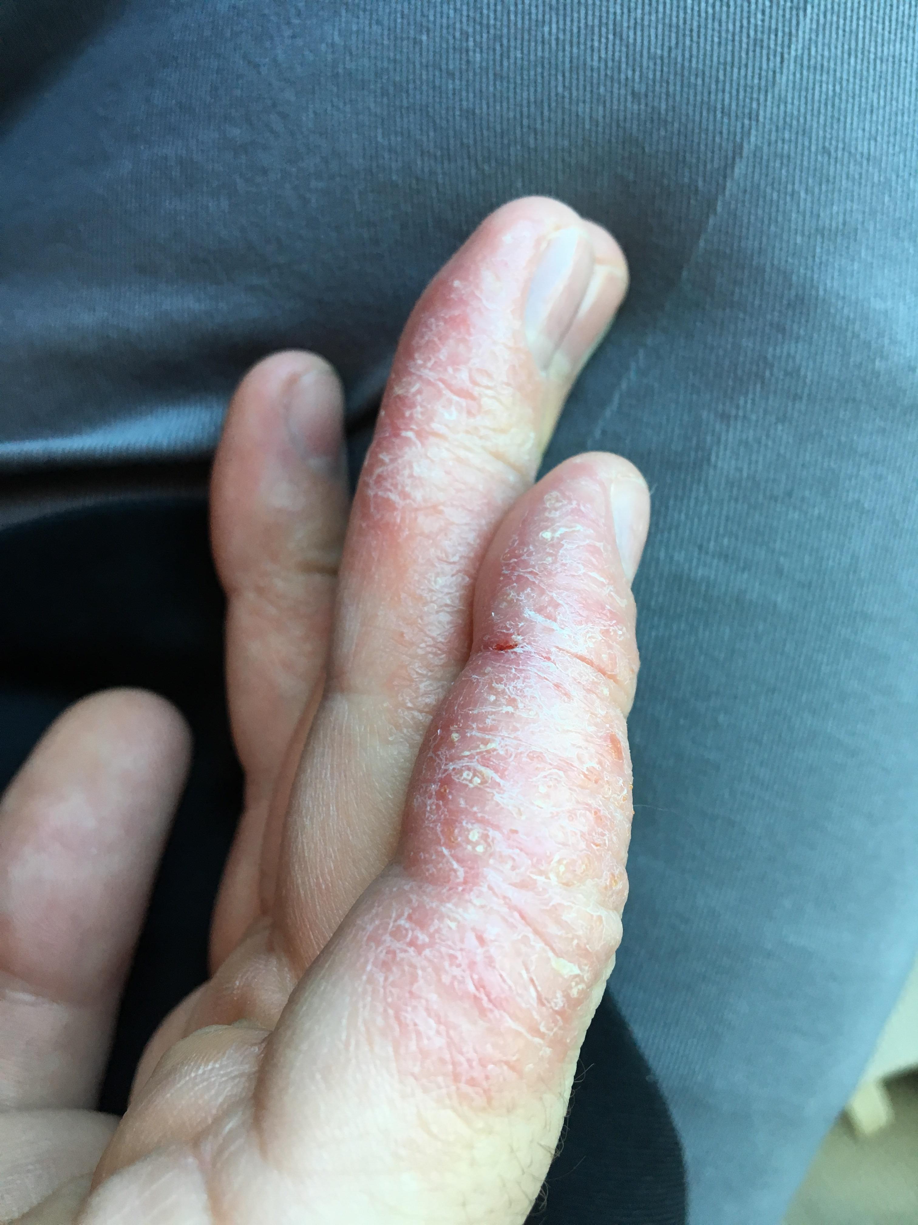 Eczema on hands [suggestions?] r/eczema