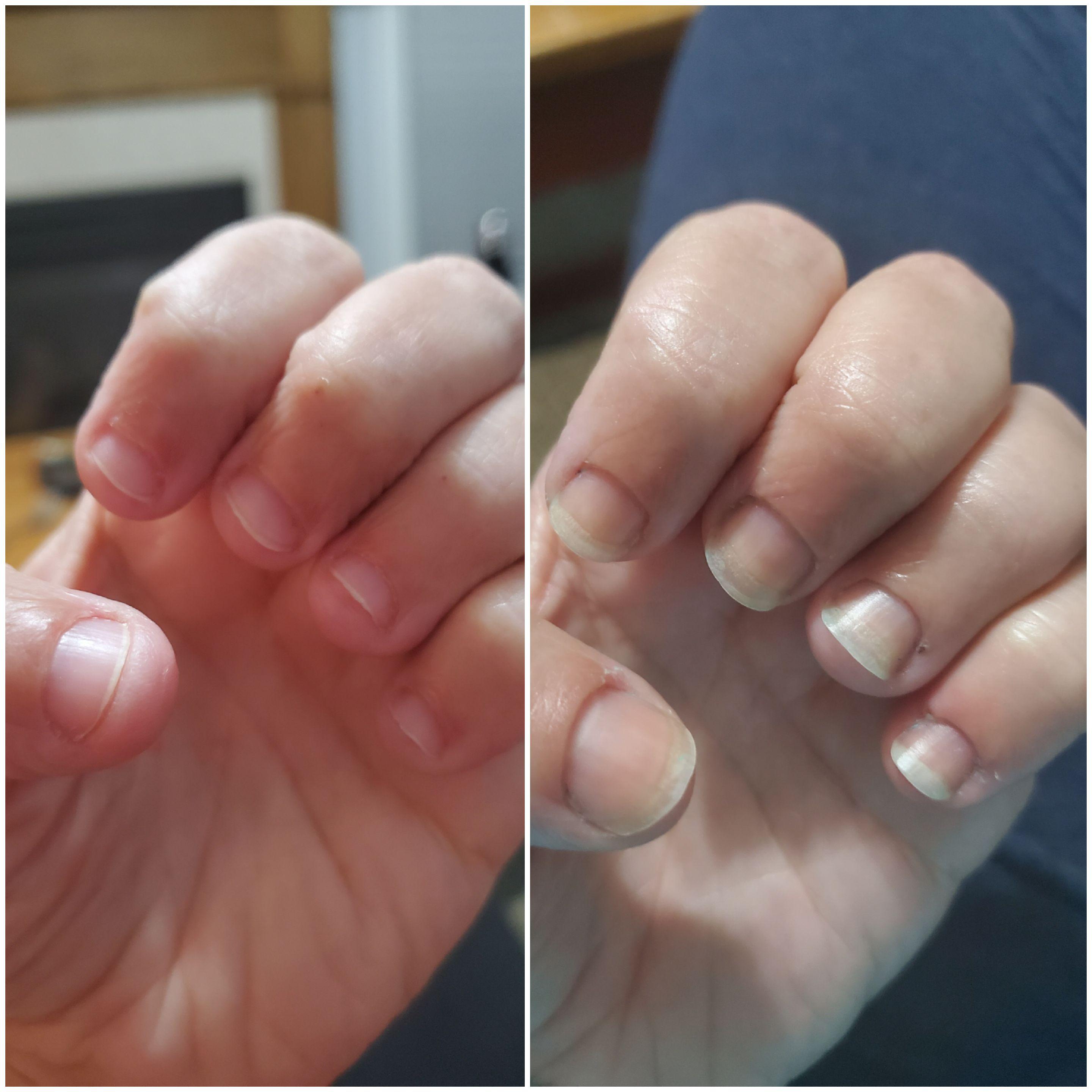 35+ years of nail biting. I know they are sooo short. Here we go again