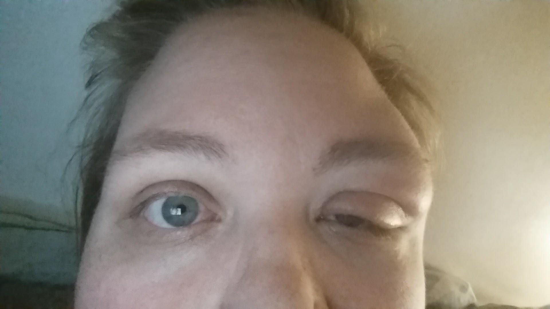 I'm allergic to mosquito bites r/Wellthatsucks