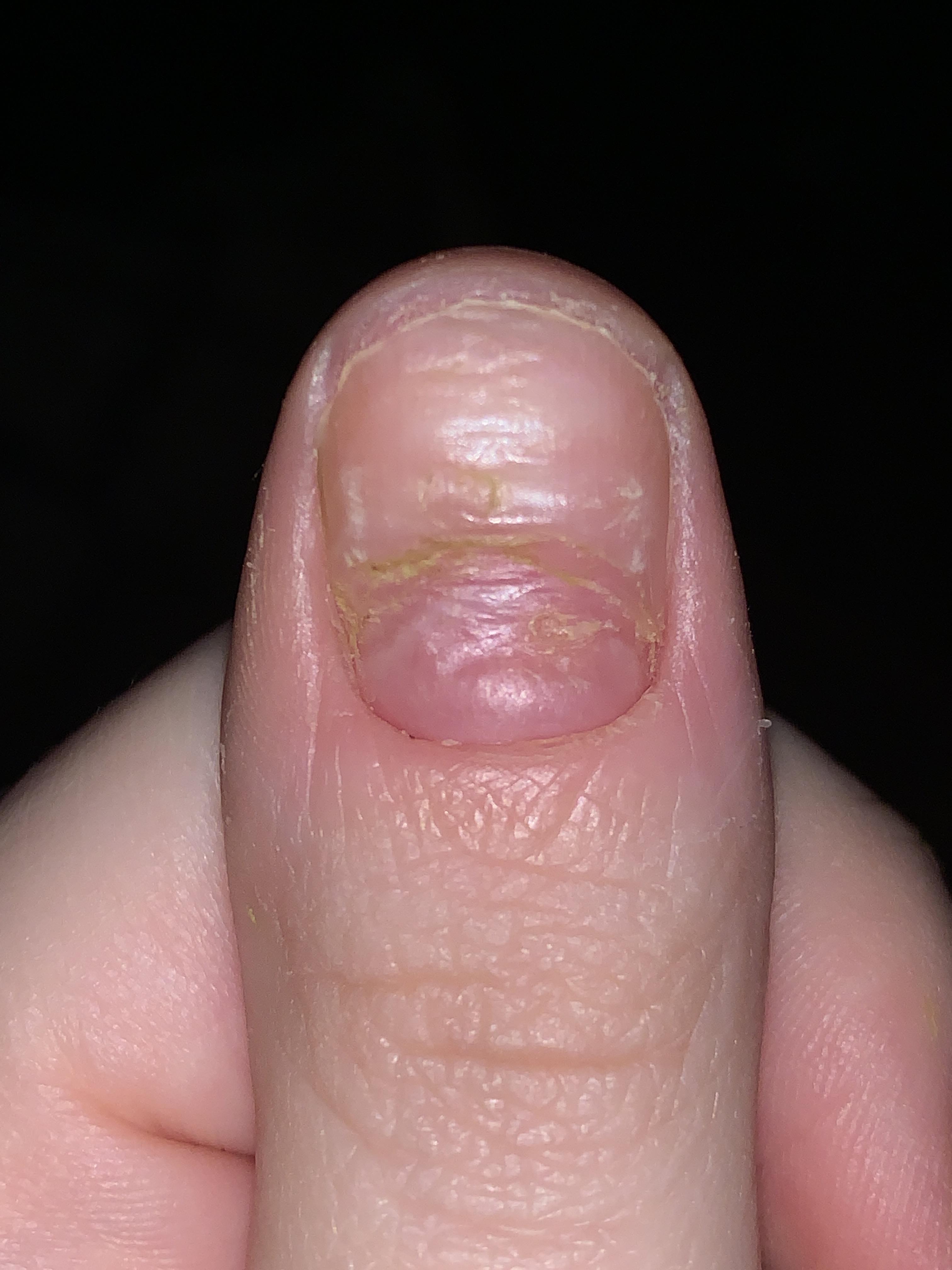 I picked to the point of getting an infection and my nail bed is