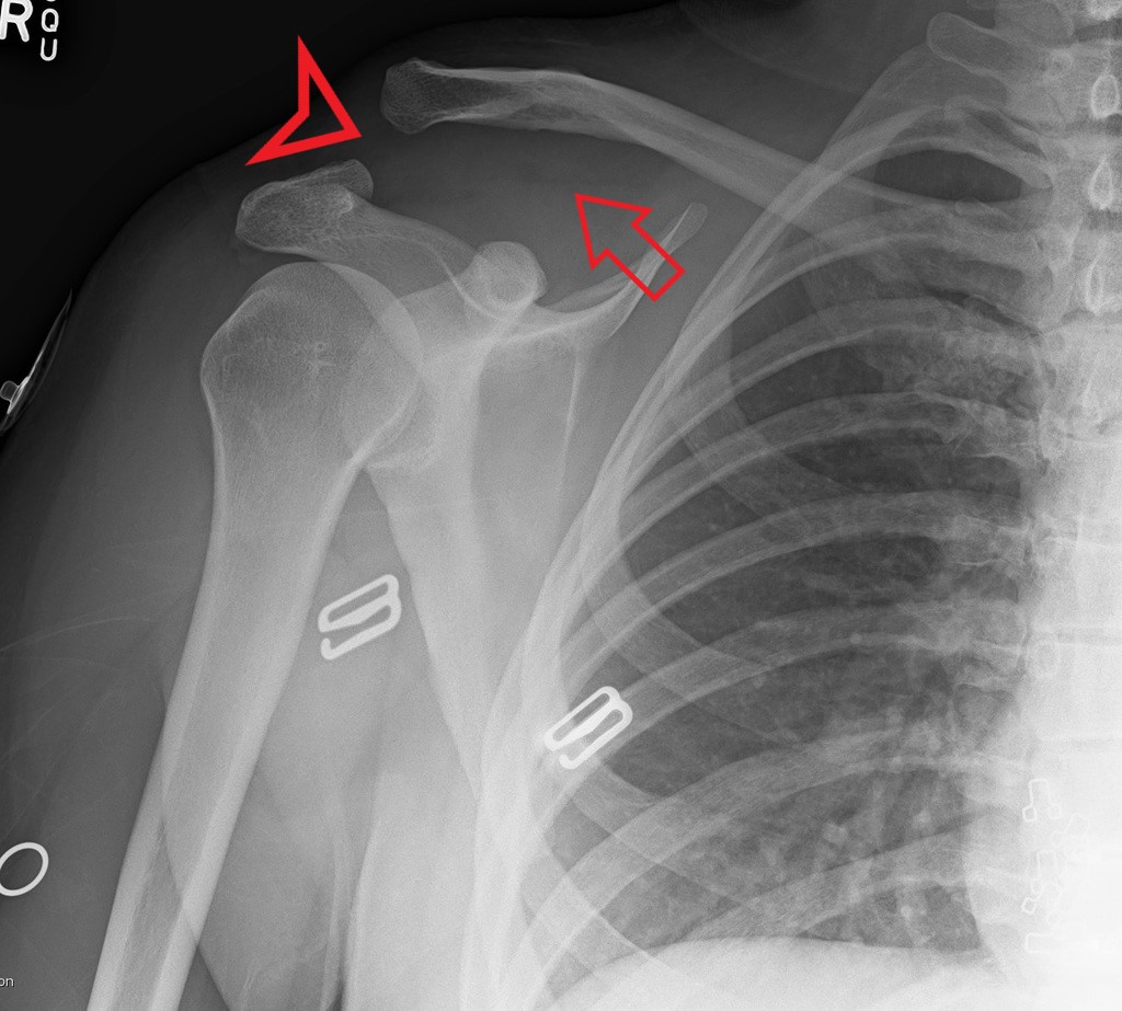 AC Joint Separation (red triangle) and widened coracoclavicular space