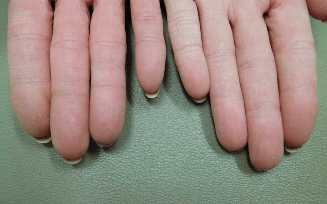 This person has no fingerprints it's a disorder called