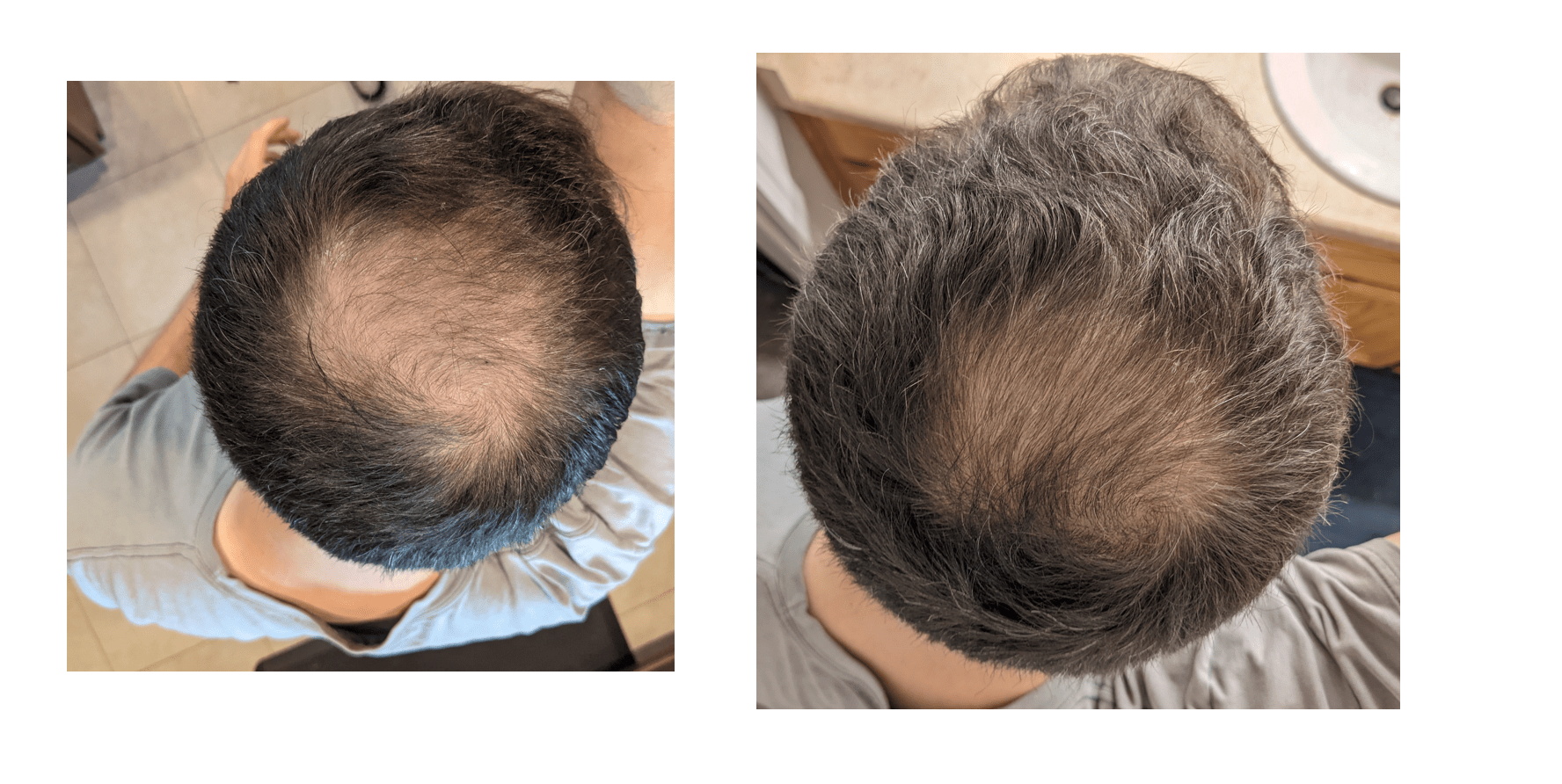 6 months of Minoxidil use once a day before and after r/tressless
