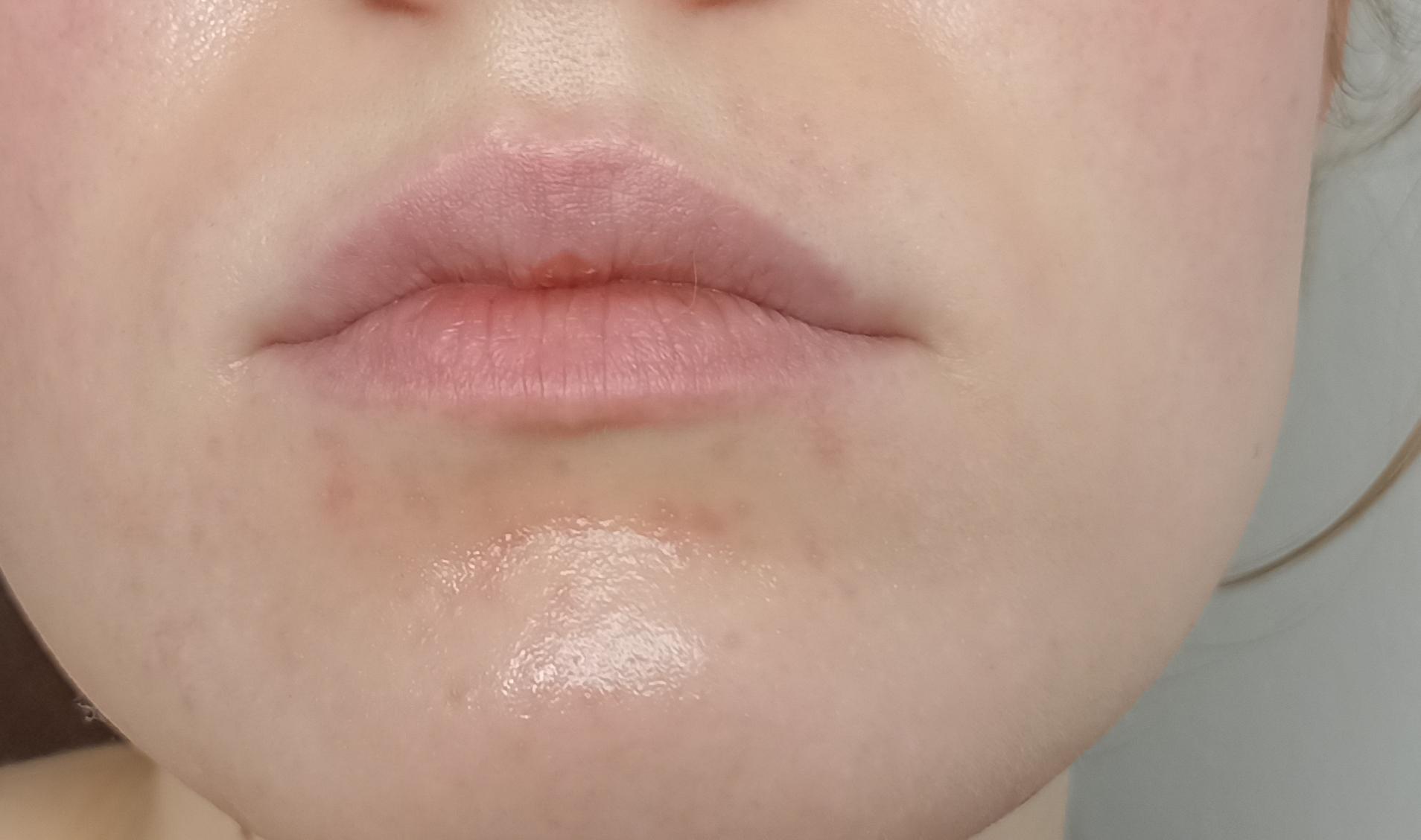 Rash around mouth appeared suddenly. What is going on ??? Slightly