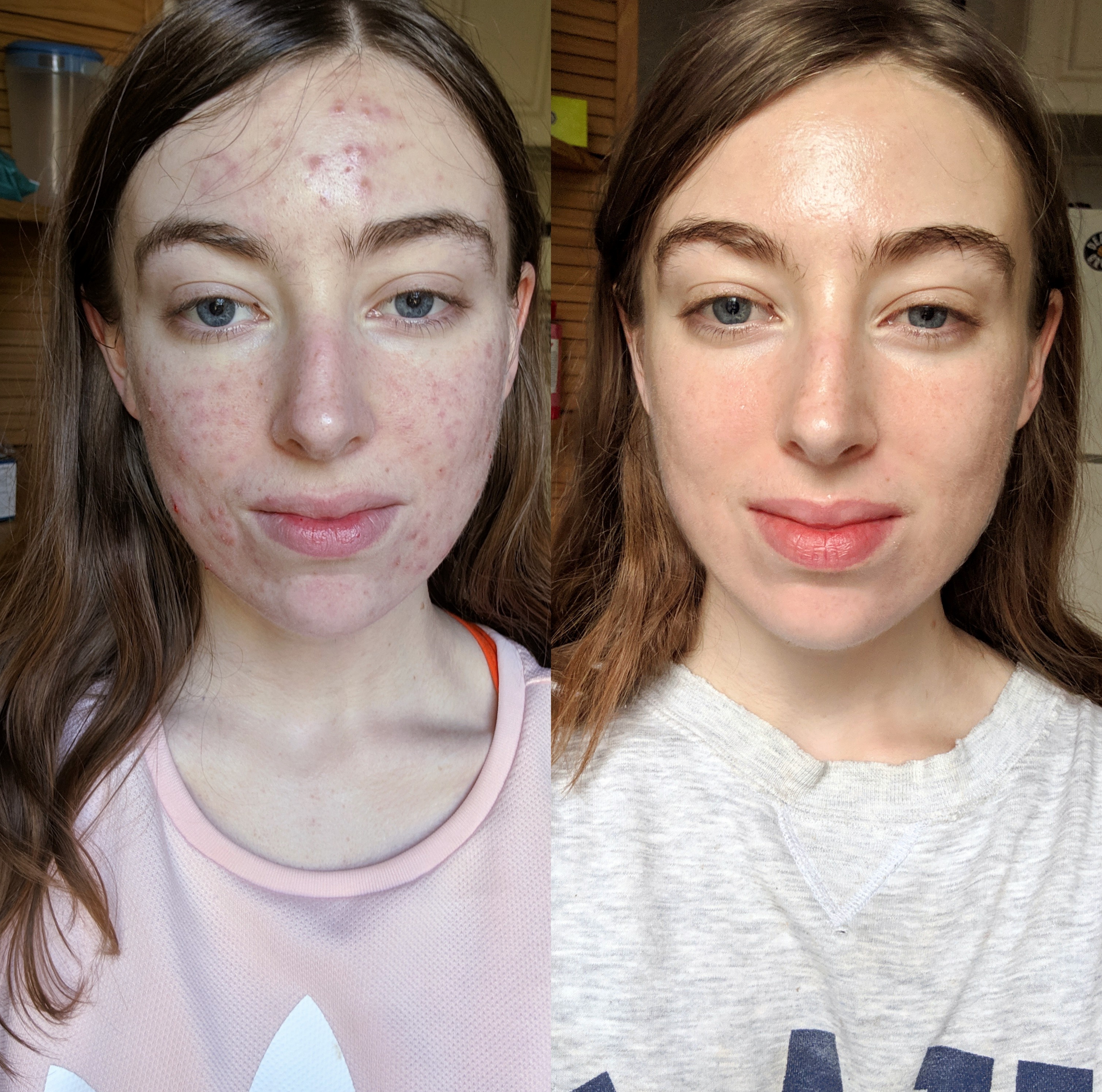 [acne] [b&a] couldn't be more thrilled with my skin after almost 5