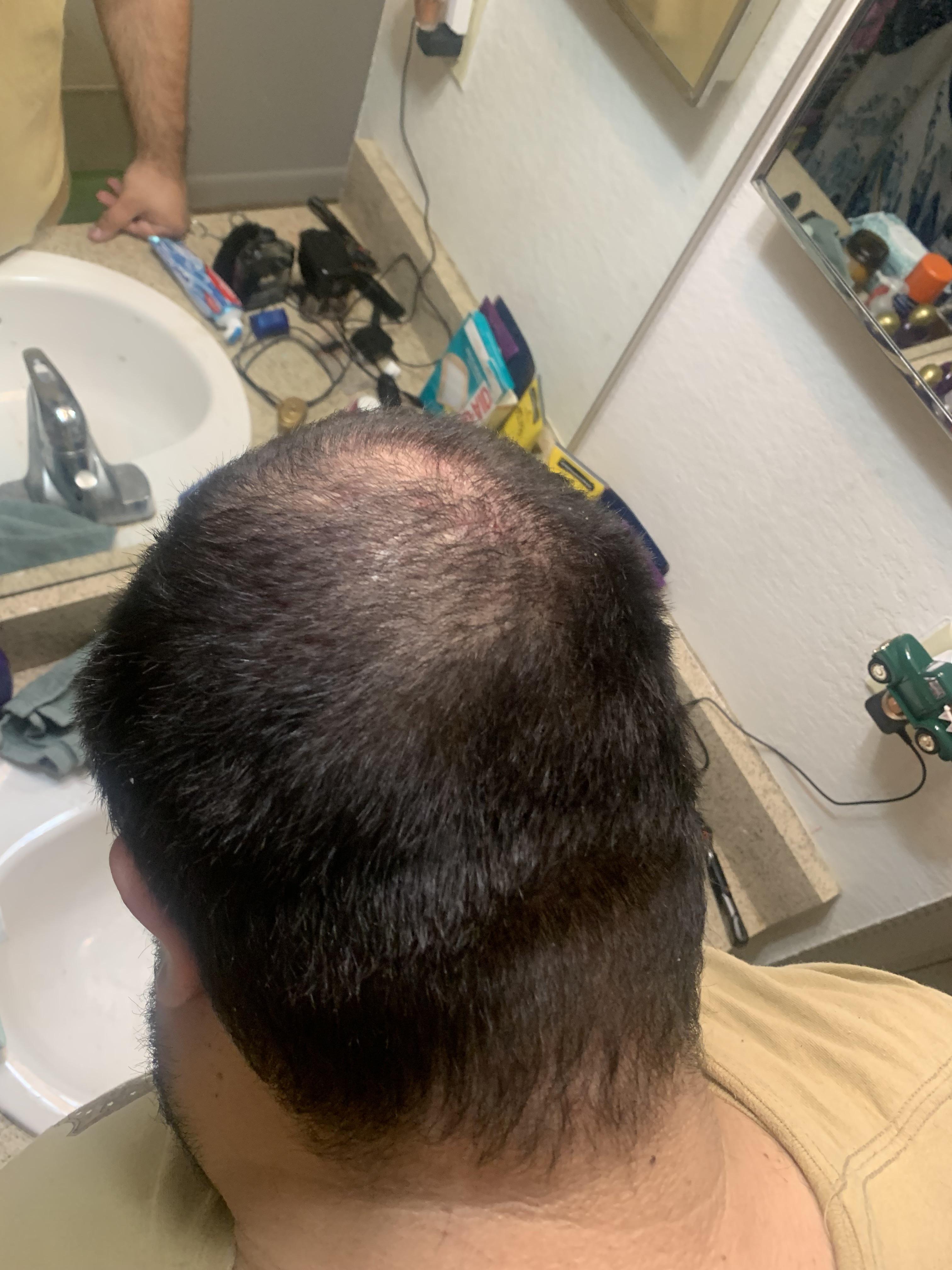 Is it normal to lose hair at the crown and the bottom of your hair? r