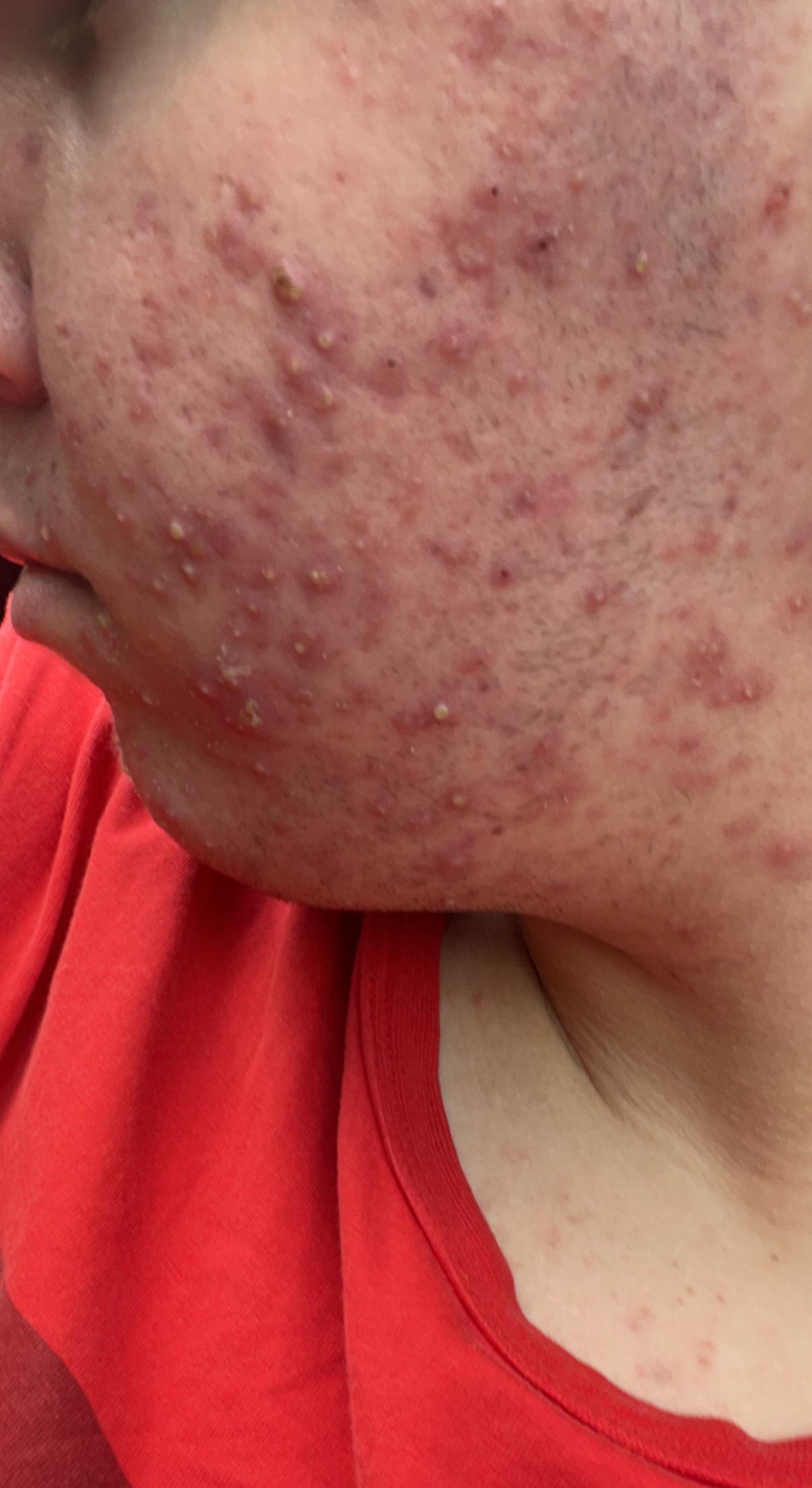 [Acne] Severe Acne for years and it's really depressing me any ideas