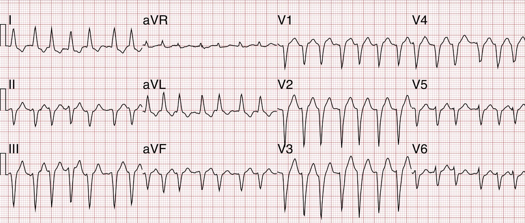 Atrial fibrillation Symptoms and causes Mayo Clinic