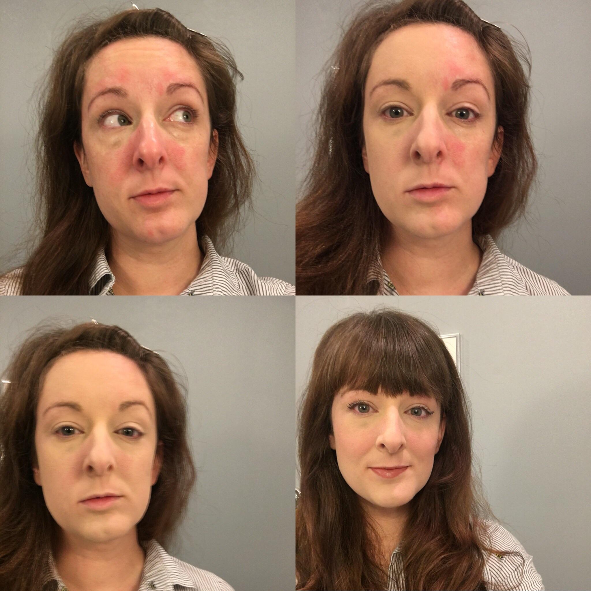 Makeup for face psoriasis r/Psoriasis