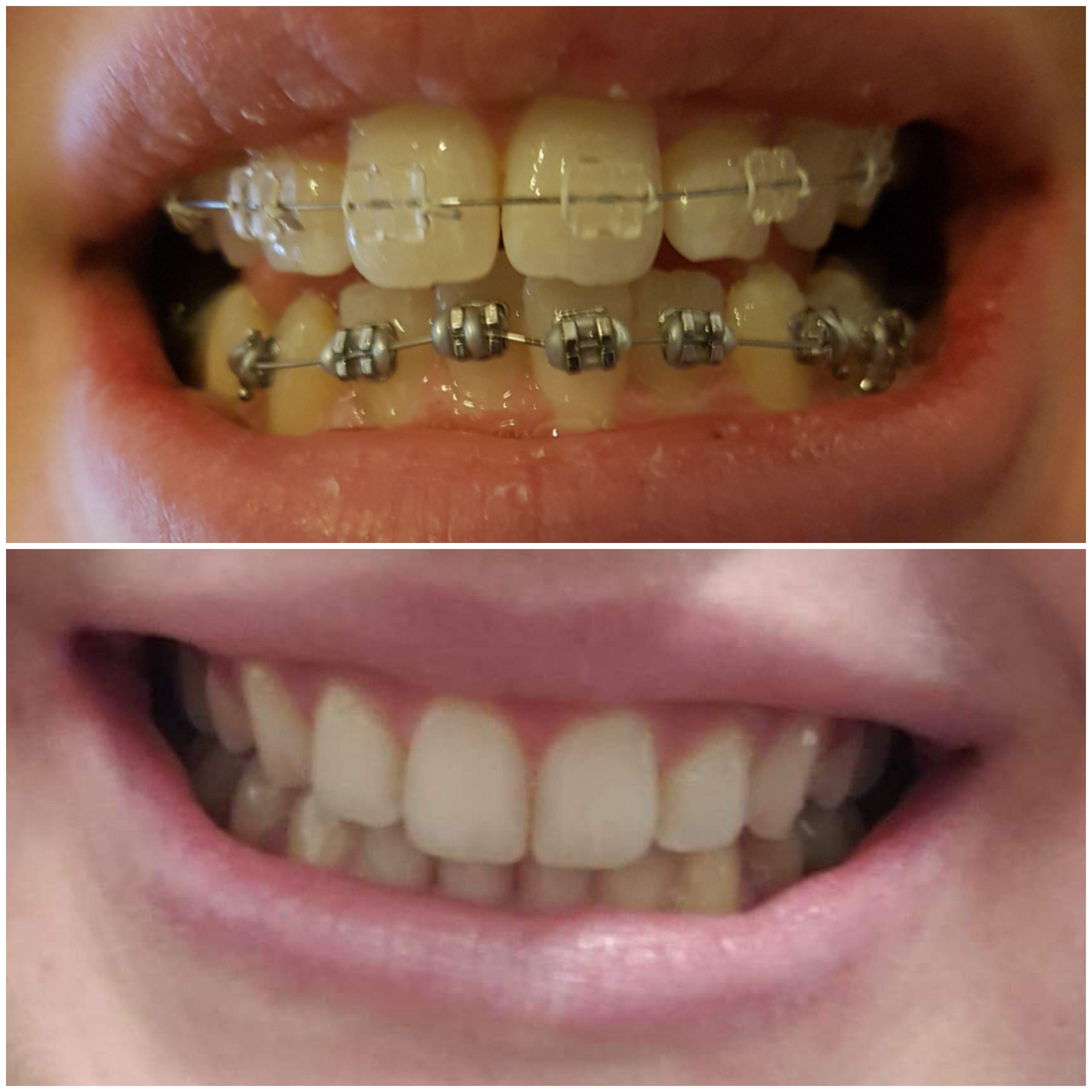 How Many Hours Does It Take To Get Braces Off How To Get My Braces