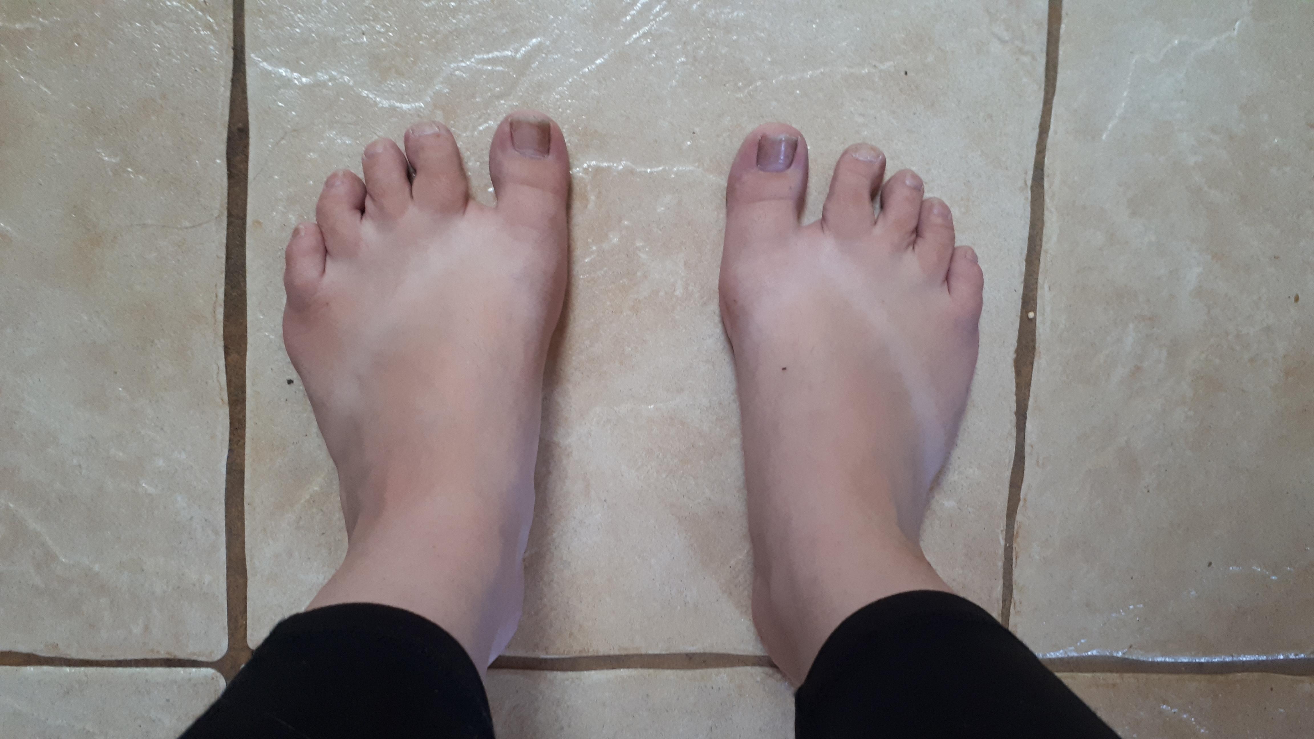Why do my feet look like they're missing a "sixth" toe, next to my big