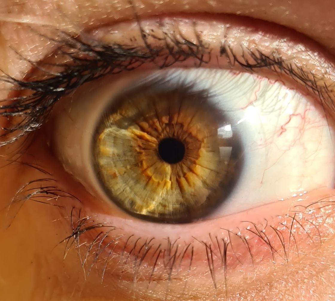 green eyes with central heterochromia r/eyes