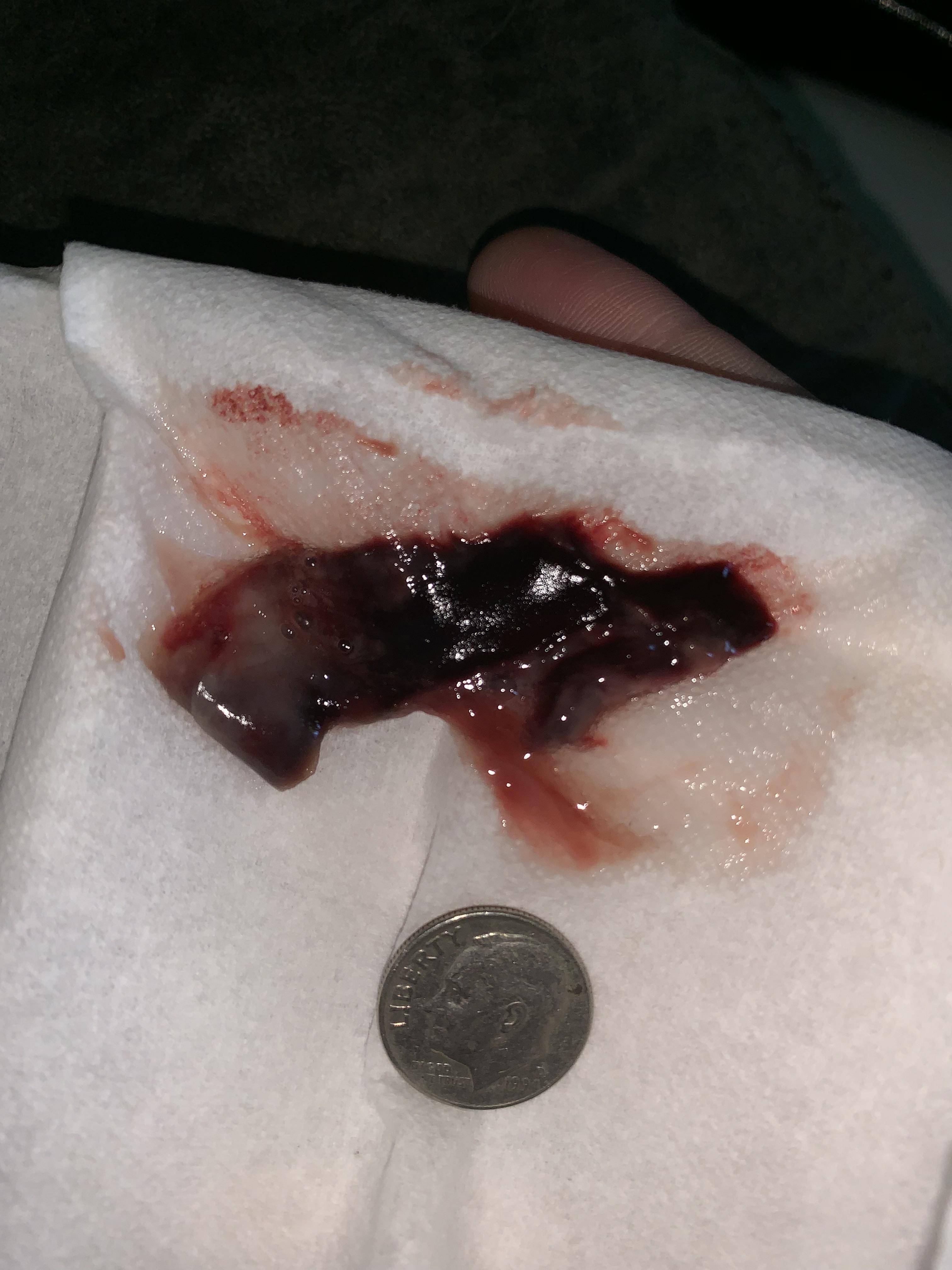 Another blood clot I spit up , 5 days post septoplasty. Dime is for scale size. r/popping