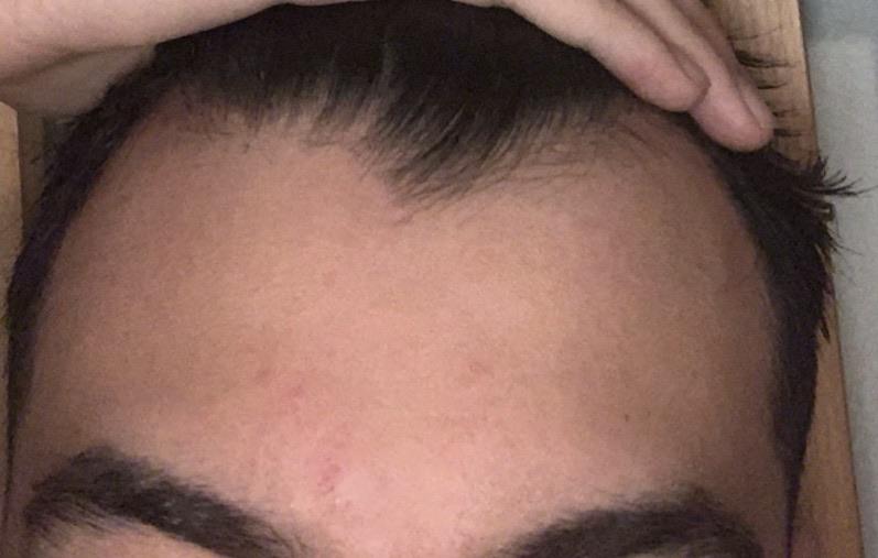 Why Is My Hair Thinning On My Hairline at David Avis blog