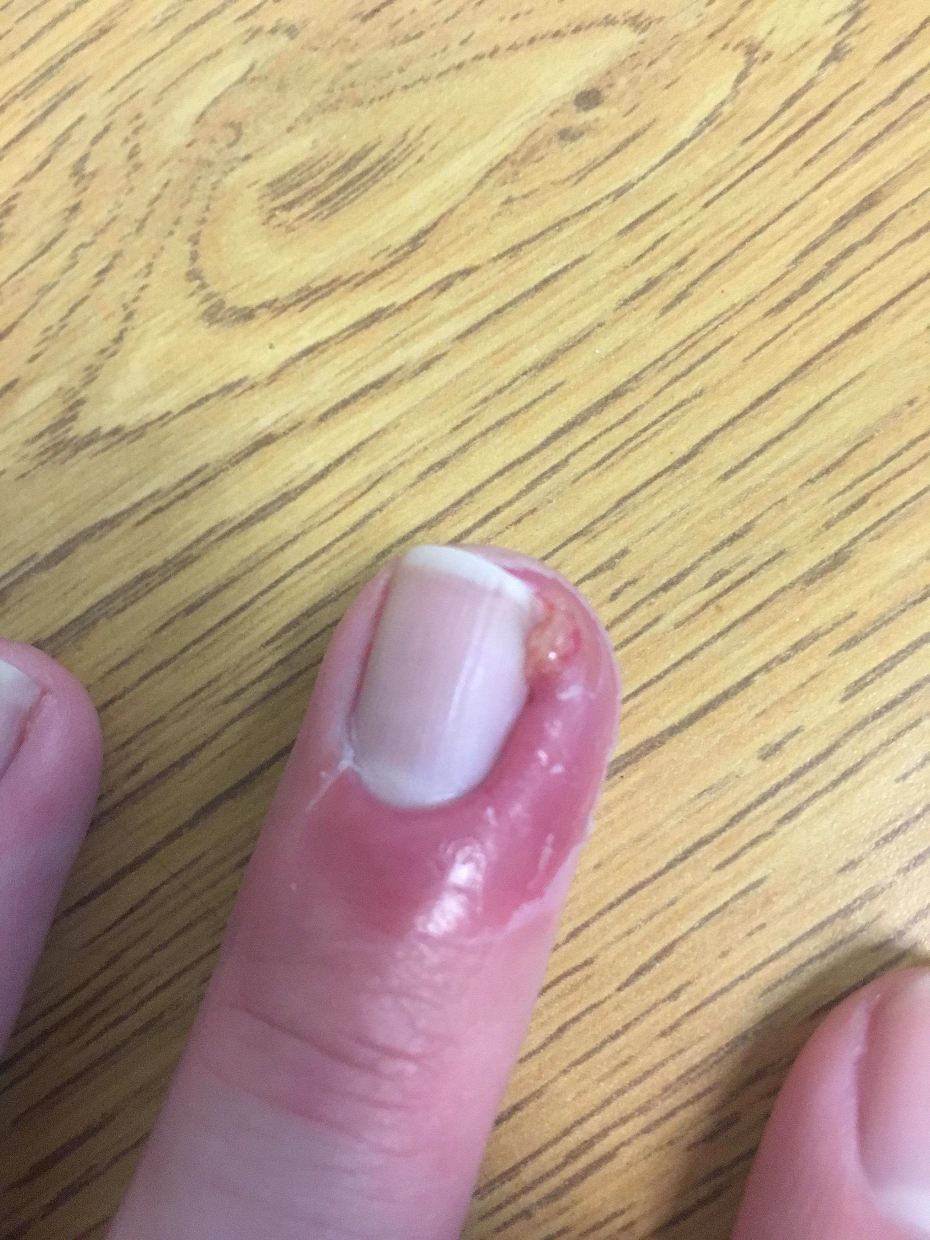 Finger swelling around nail, any of y’all experience this? r/Accutane