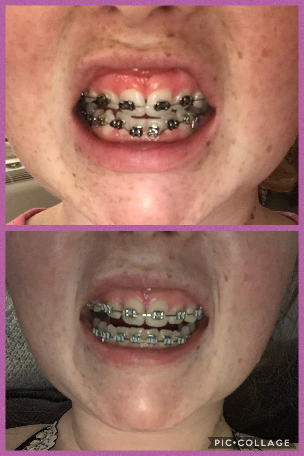 It’ll be 6 months next week! I get rubber bands on the 9th. So excited about the progress! r