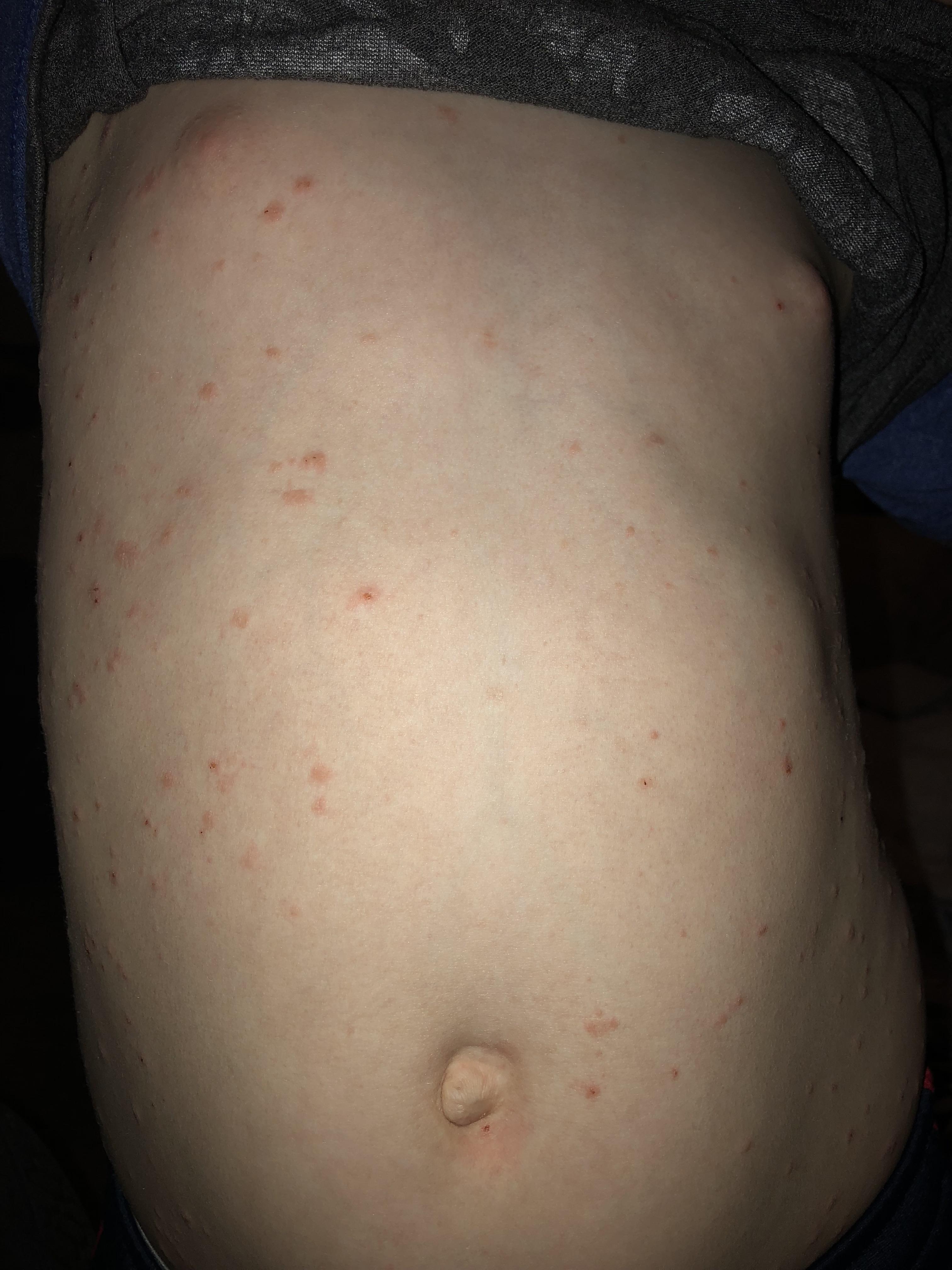Any idea what this could be on my son? Not chicken pox