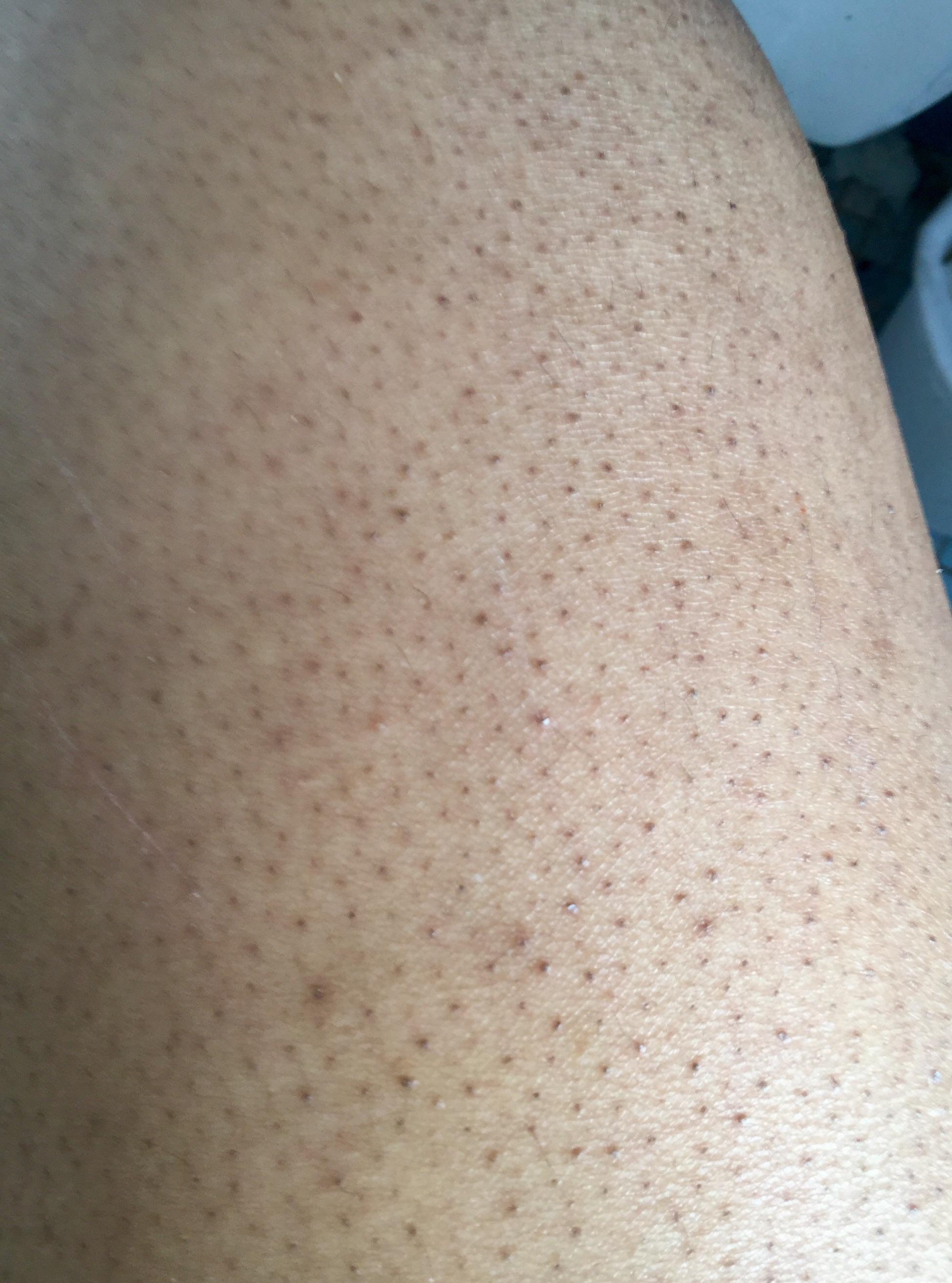 [Skin concerns] My poor thighs ’( They always feel/look like a big