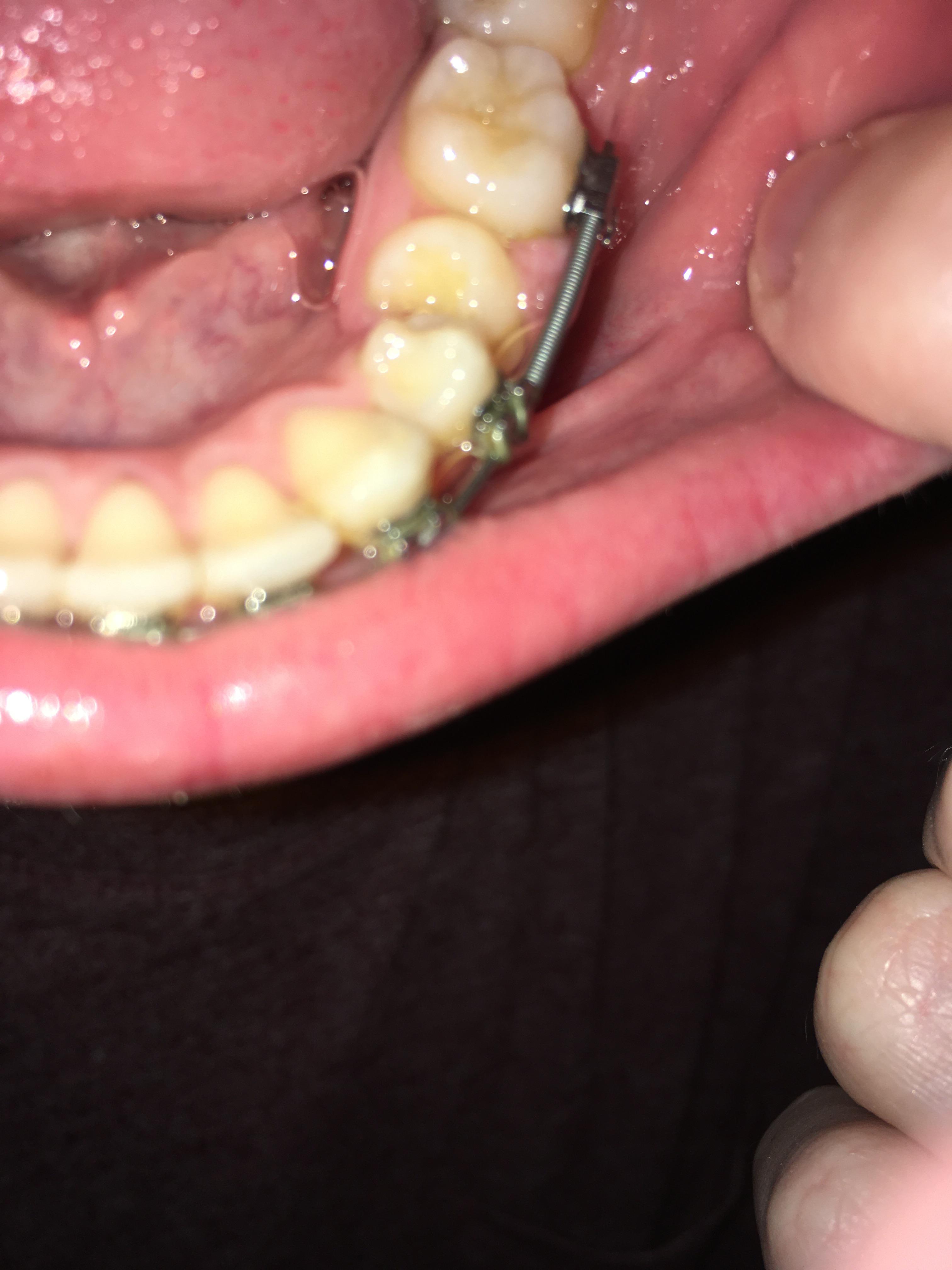 Swollen gum caught between coil spring and tooth. Can anyone suggest