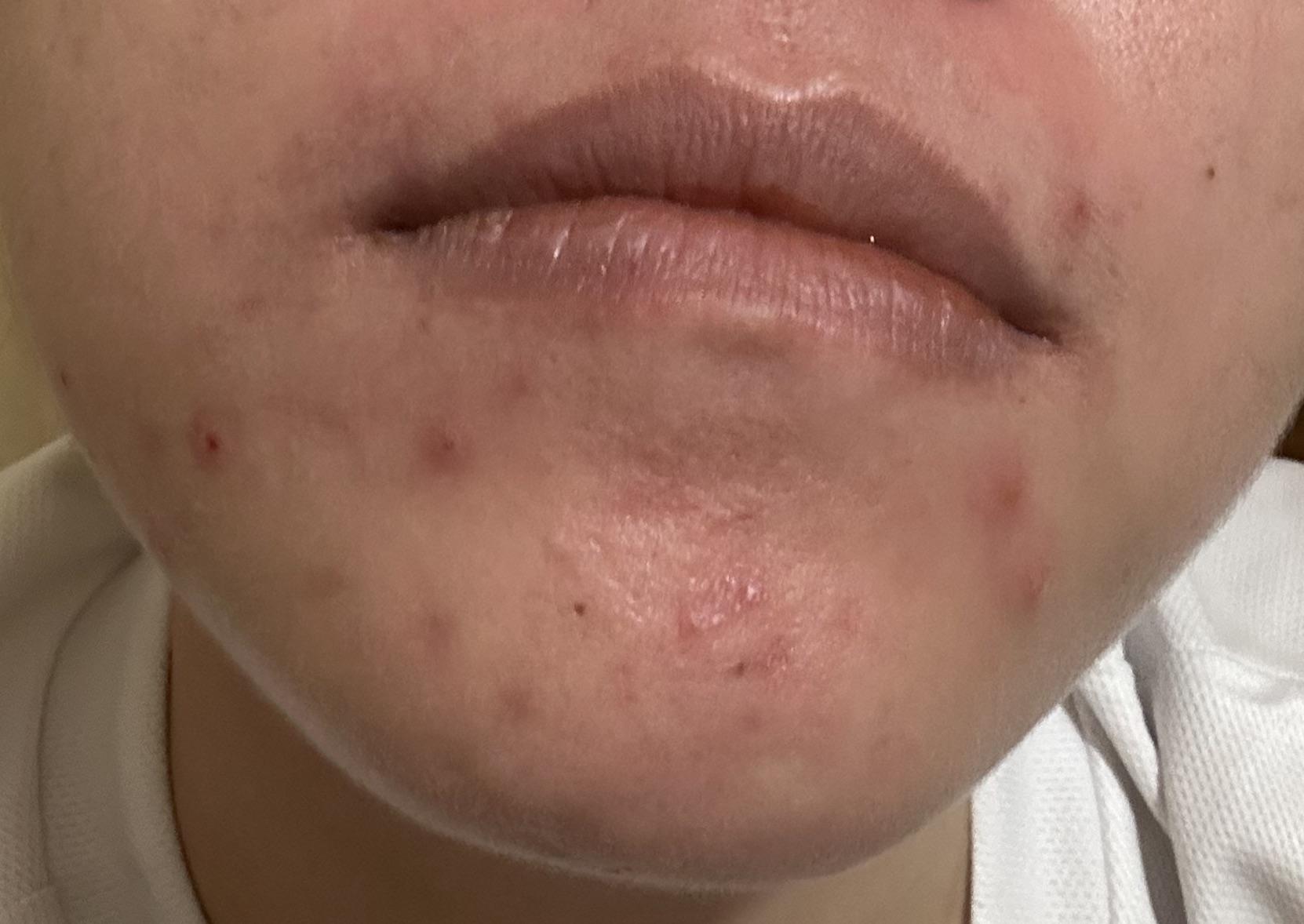 [acne] Almost 3 months of 50mg spironolactone, no birth control. Is