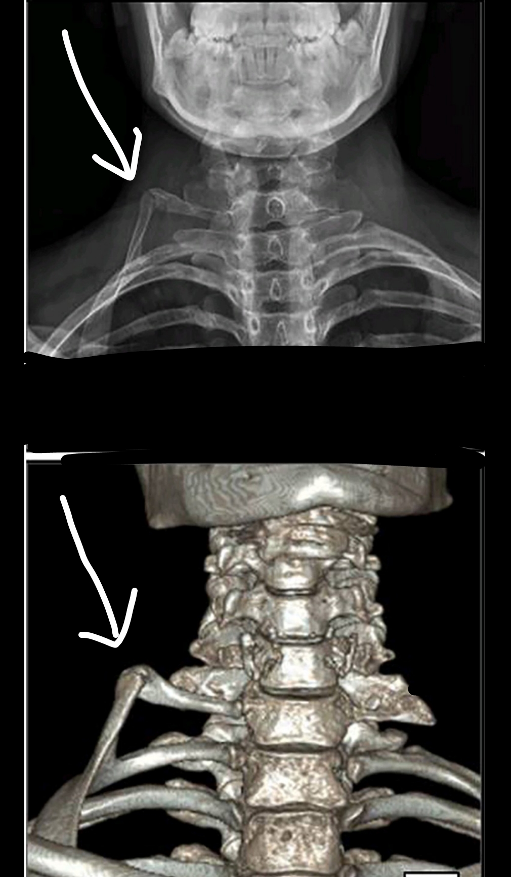 An xray and tomography of a cervical rib an extra rib on the C7