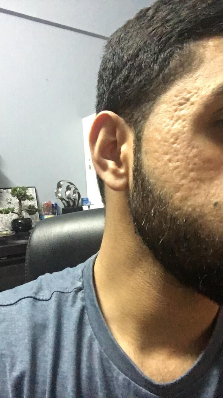 [Acne] Been suffering with post acne scars for a few years now. No