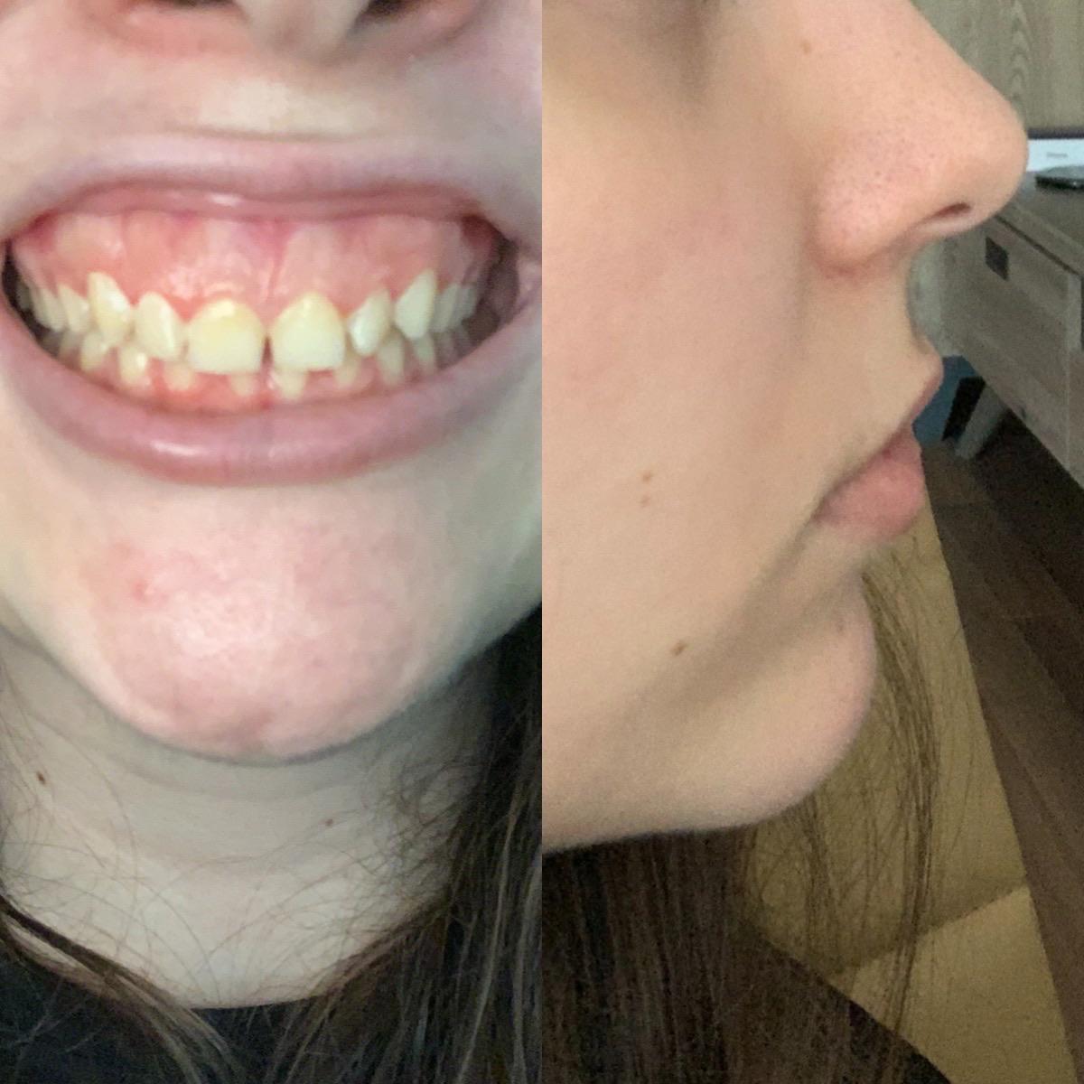 Overbite & extremely small teeth here! r/braces