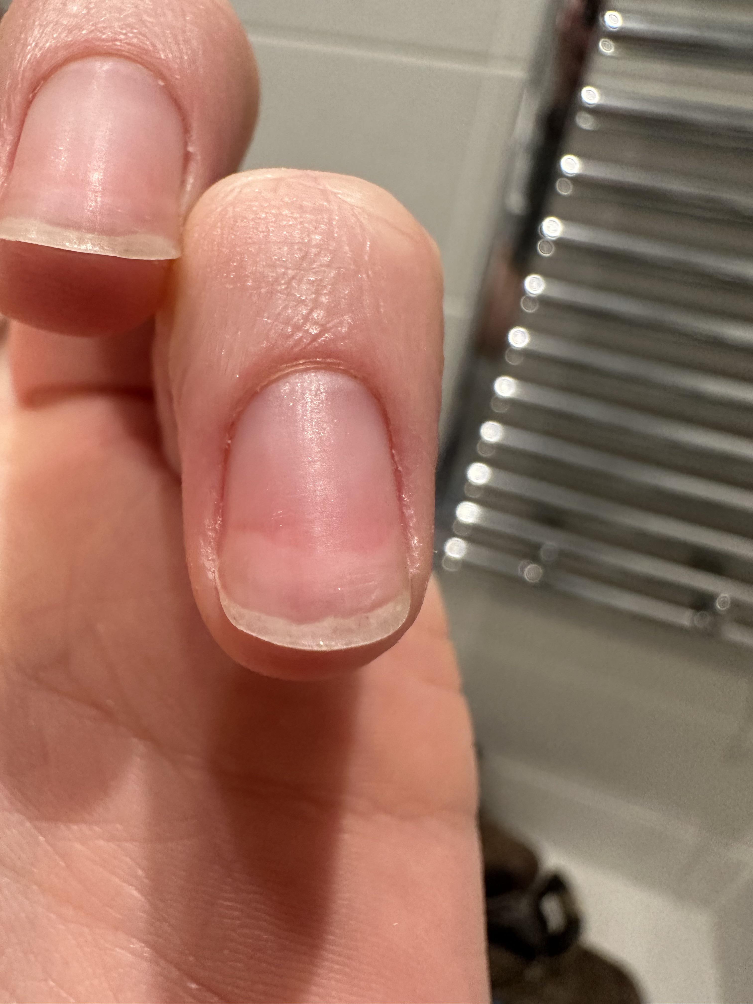 Discoloration of skin under nails🙈? r/Nails