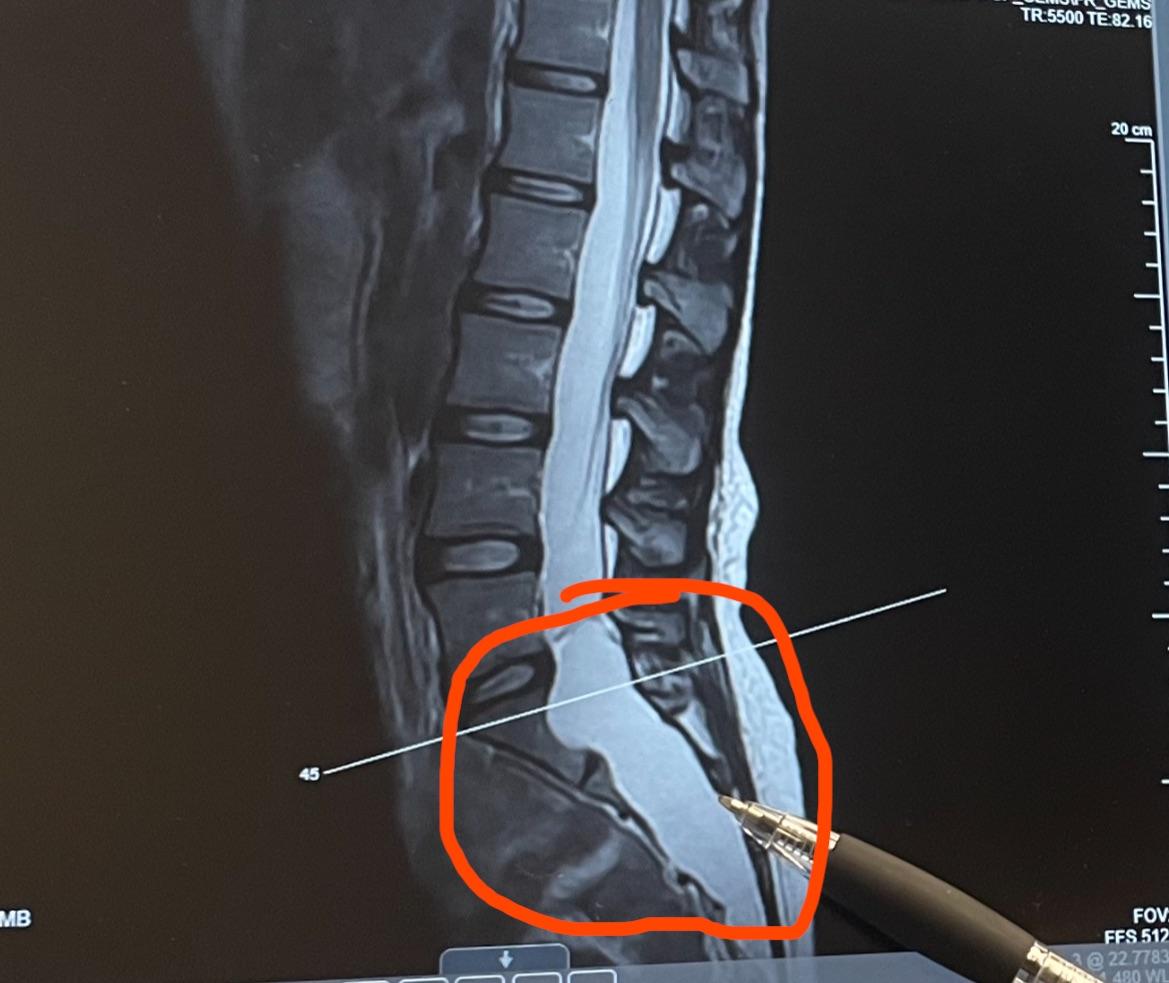 Tarlov cyst advice r/Tarlovcyst