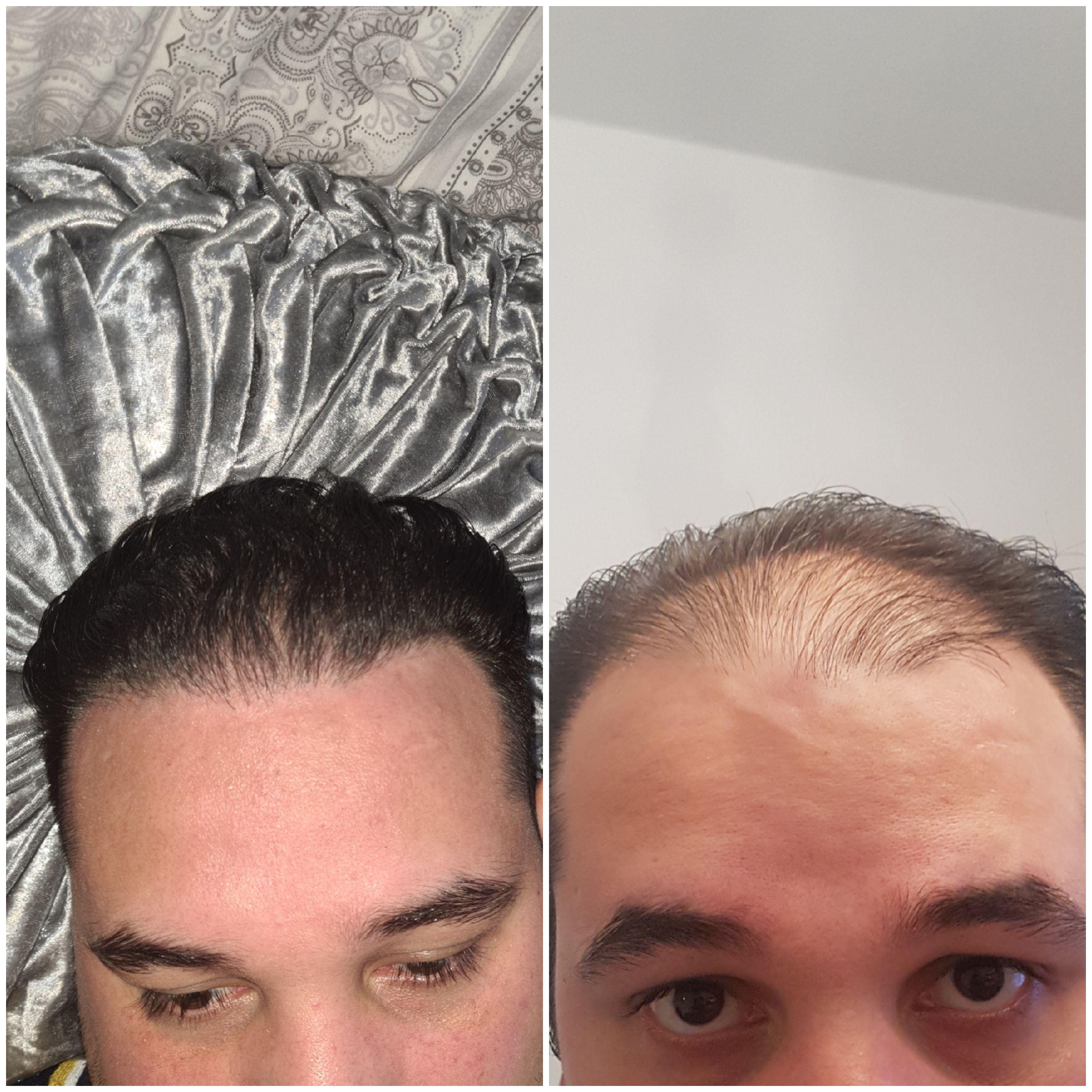 2nd hair transplant done in UK for the same price as the 1st which I done in turkey and failed