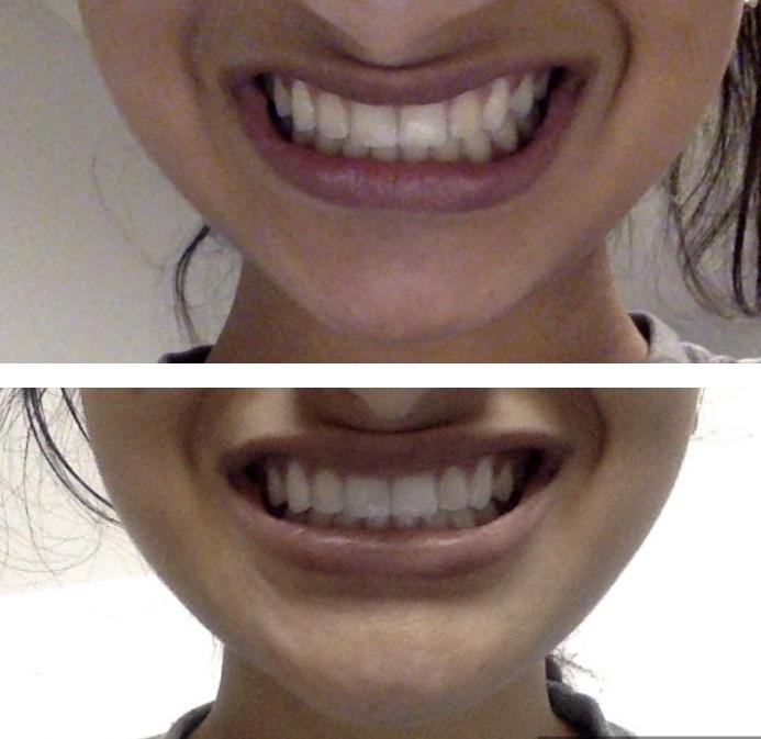 Corrected orthodontic relapse r/Invisalign