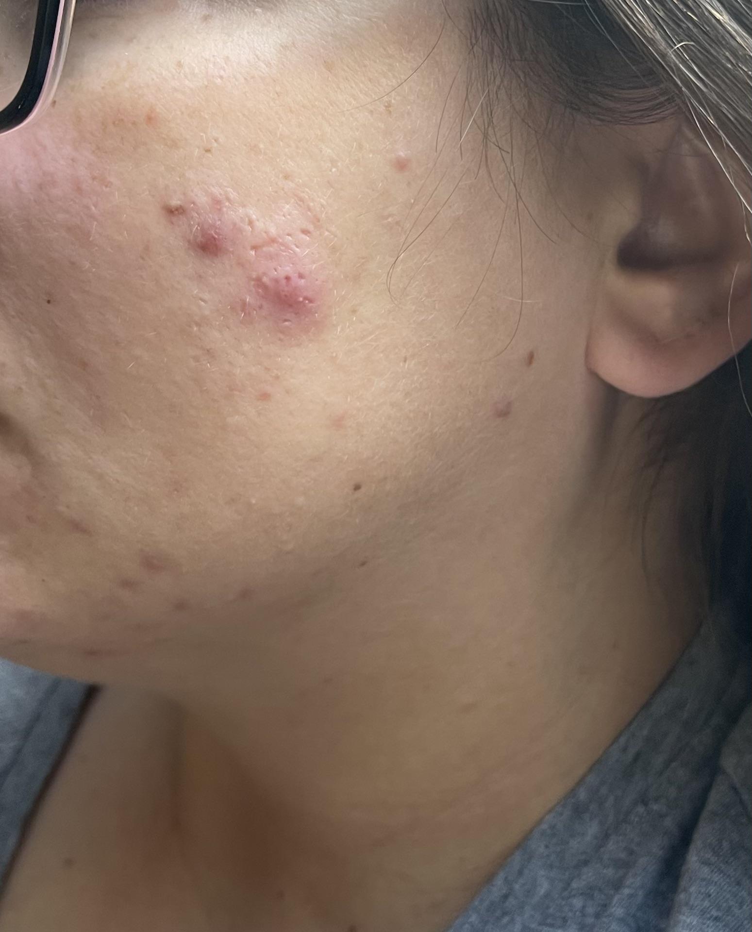 Hard “ball” under skin r/SkincareAddicts