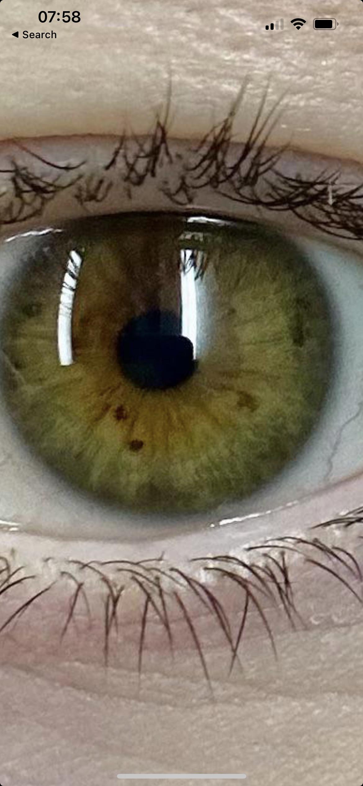 Are the black dots in my eye anything to worry about? Only in one eye