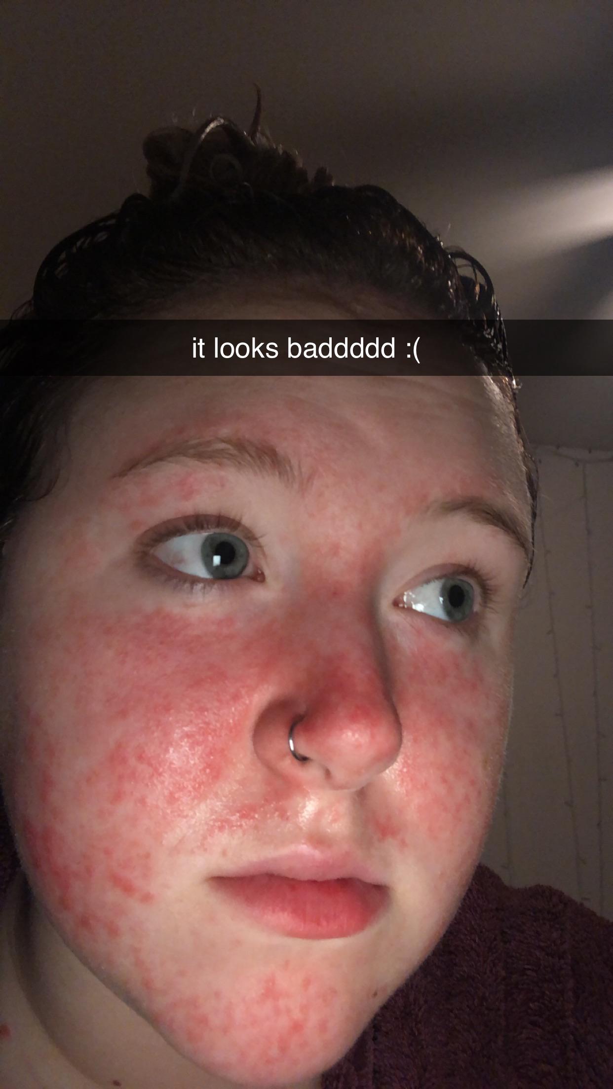 Been stuck with this rash for over 50 days! I’ve been on bactrim