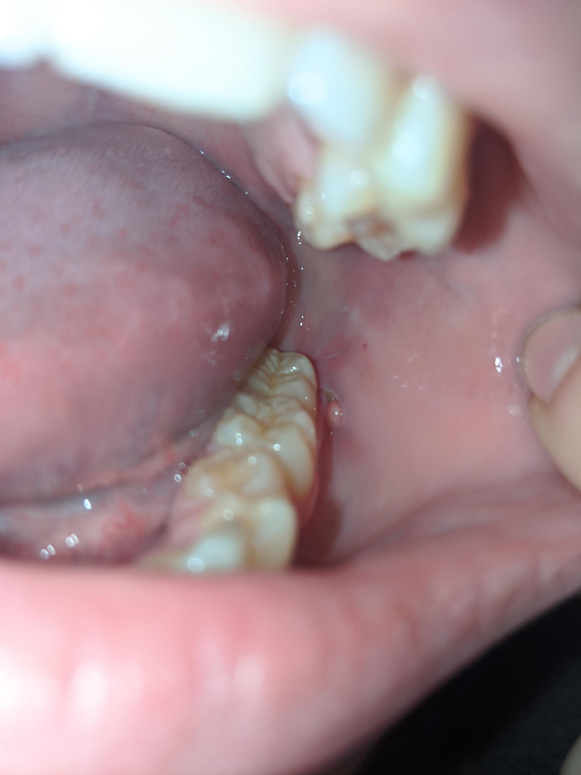 got my wisdom teeth removed 3 weeks ago, now there is a small bump on
