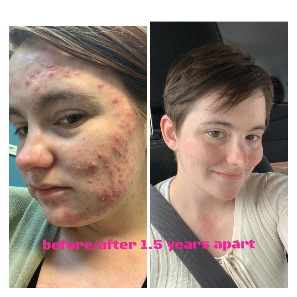 [Acne] Breastfeeding caused hormones which caused this acne r