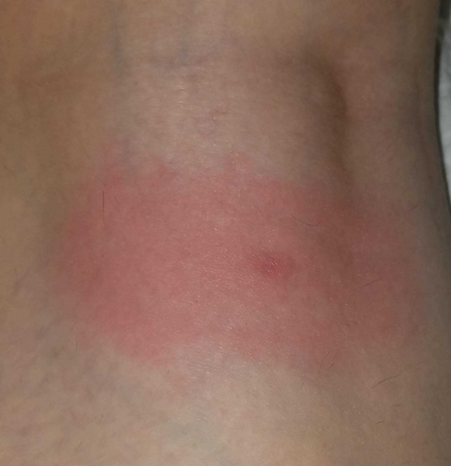 Can bug bites cause fevers? (New Jersey) I got a painful bite earlier