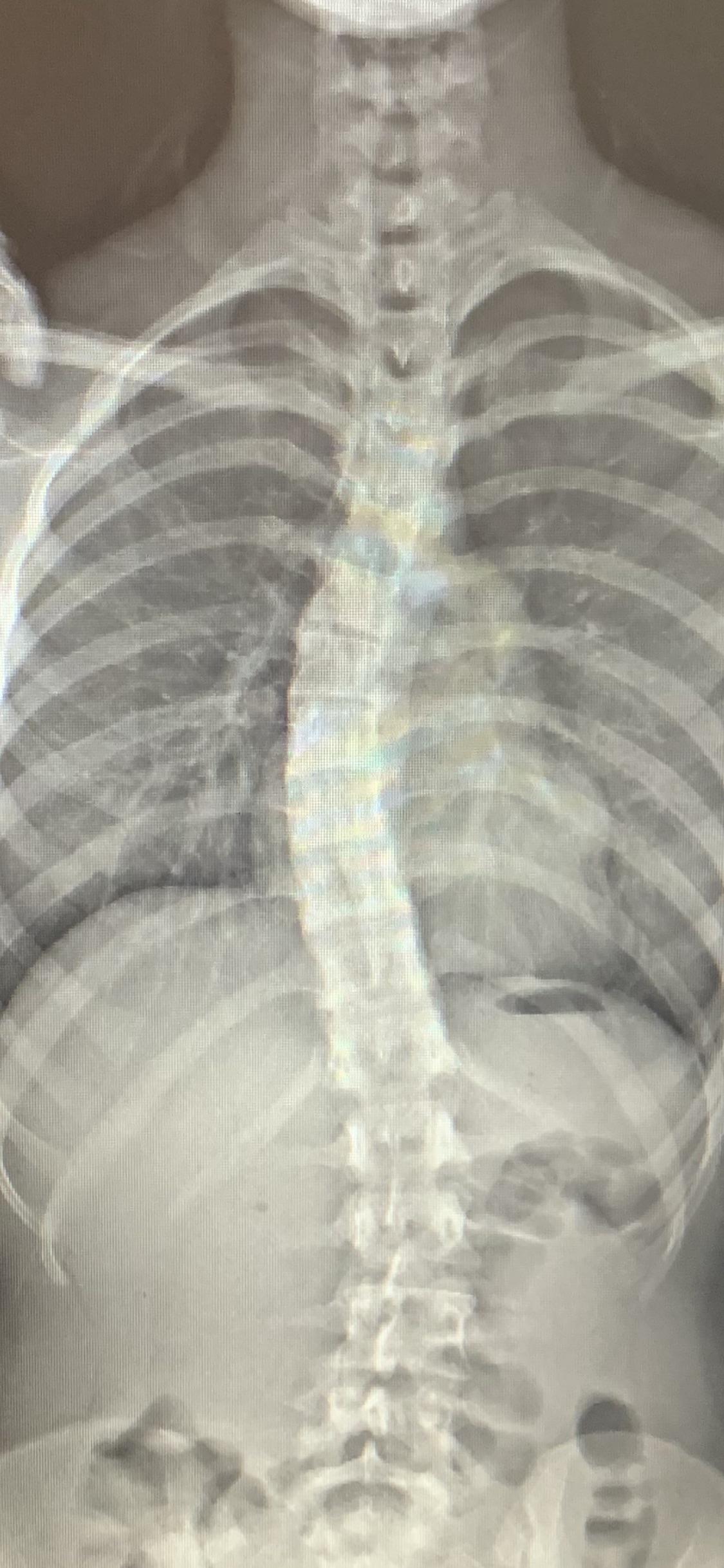 Curious about different therapy options and ways to lessen rib humps